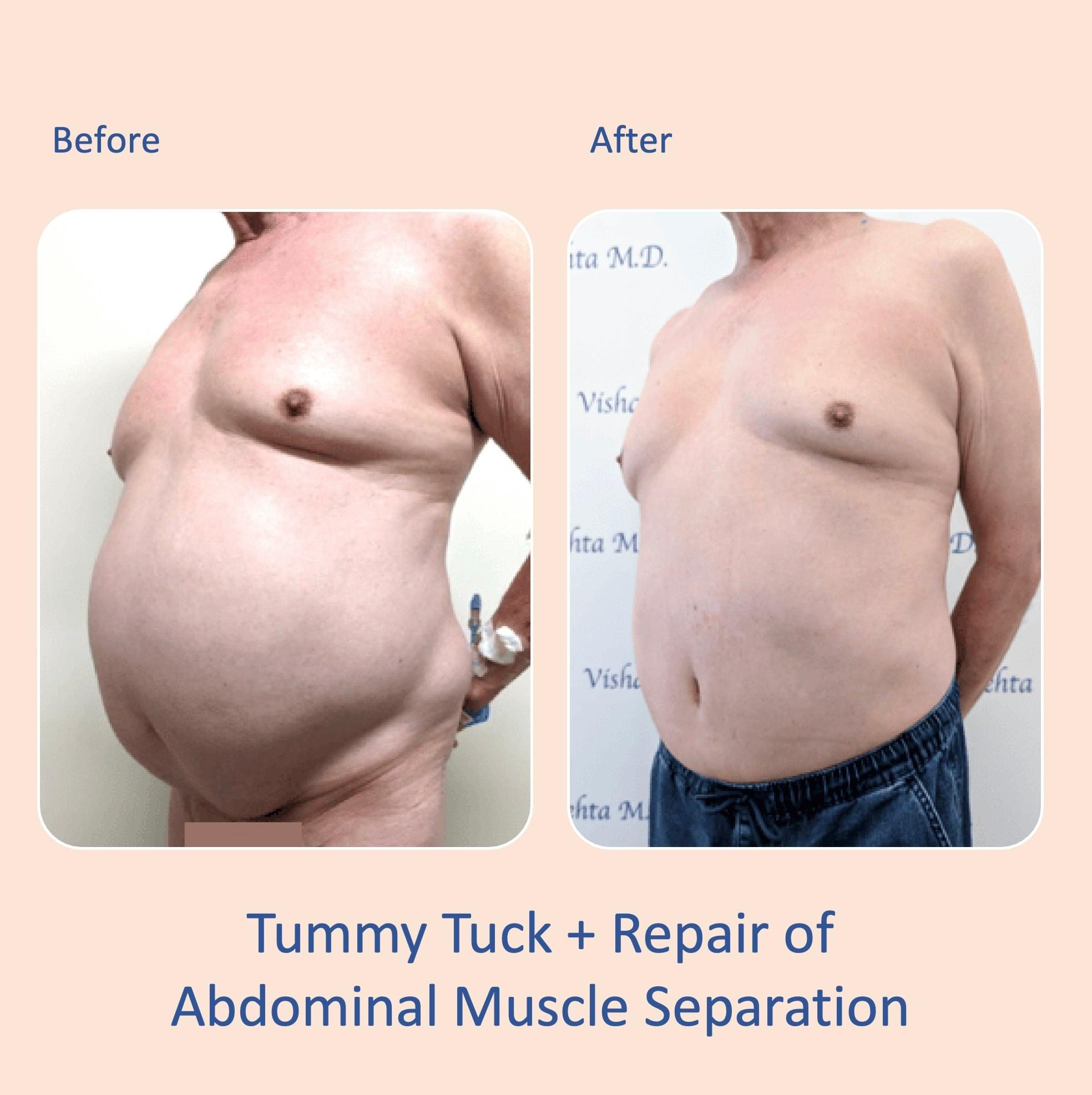 Before & after results of male, men, abdominoplasty, tummy tuck, panniculectomy performed by Dr. Vishal Mehta, top bariatric Surgeon serving Central NJ, Princeton, Montgomery, and surrounding areas.