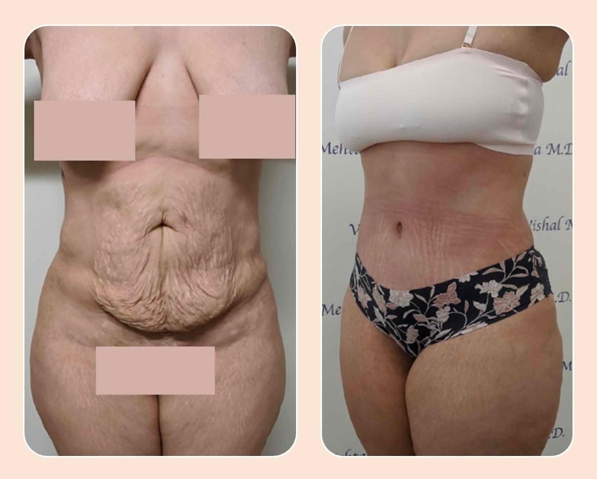 Before & after results of tummy tuck and liposuction, lipo-sculpting performed by Dr. Vishal Mehta, top Liposuction Surgeon serving Central NJ, Princeton, Montgomery, NJ and surrounding areas.