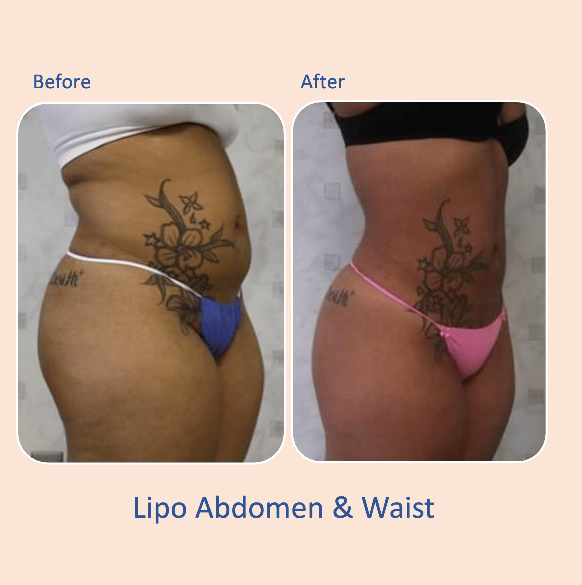 Before & after results of awake liposuction, lipo-sculpting performed by Dr. Vishal Mehta, top Liposuction Surgeon, Central NJ