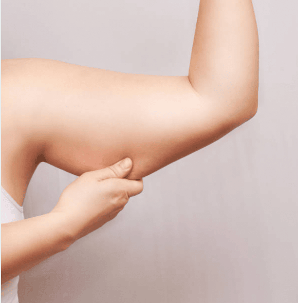 Before & after results of awake mini-tummy tuck and liposuction, lipo-sculpting performed by Dr. Vishal Mehta, top Liposuction Surgeon, Central NJ