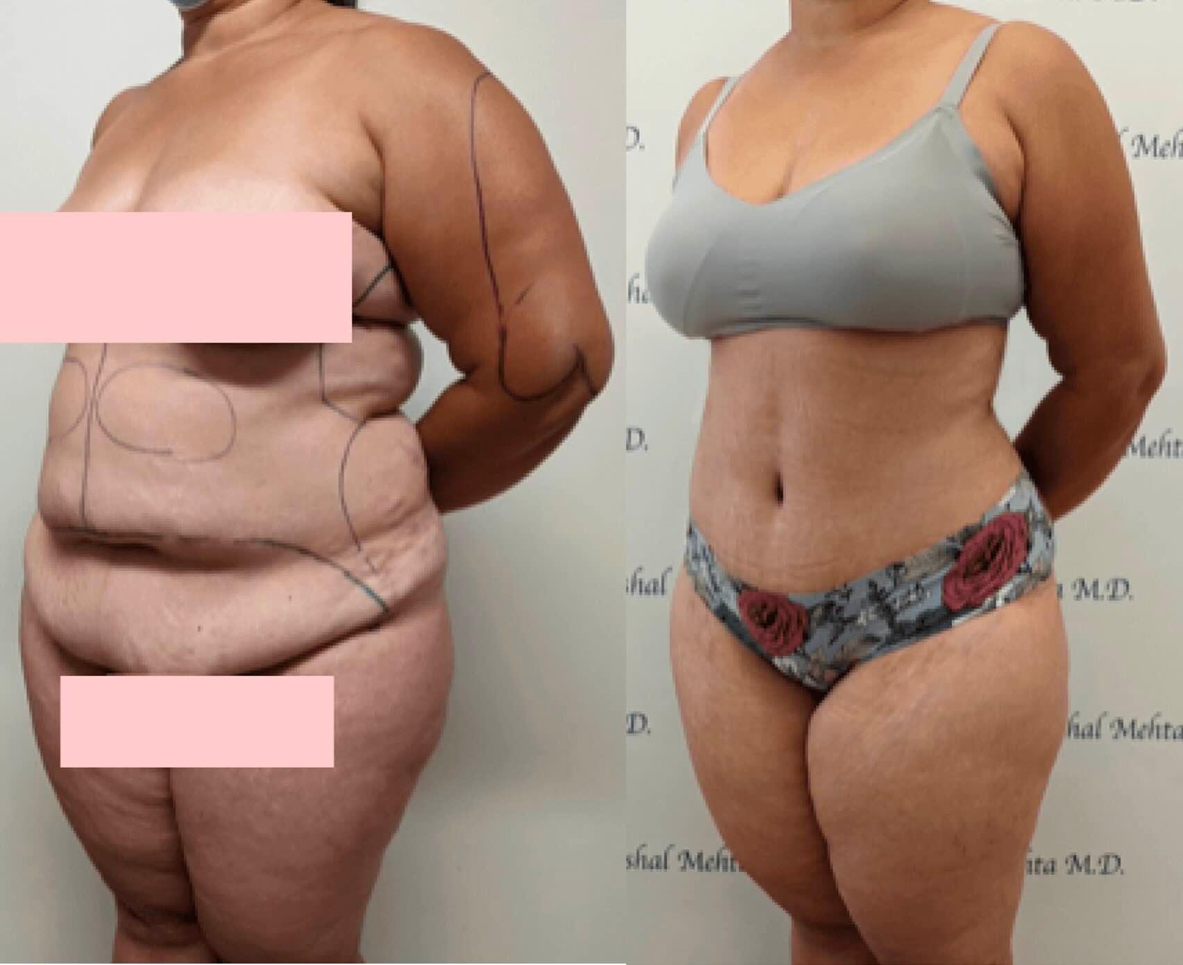 Before & after results of awake liposuction, lipo-sculpting performed by Dr. Vishal Mehta, top Liposuction Surgeon, Central NJ