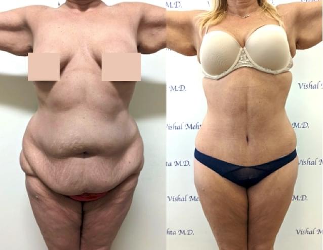 Before & after results of abdominoplasty, tummy tuck, panniculectomy performed by Dr. Vishal Mehta, top bariatric Surgeon serving Central NJ, Princeton, Montgomery, and surrounding areas.
