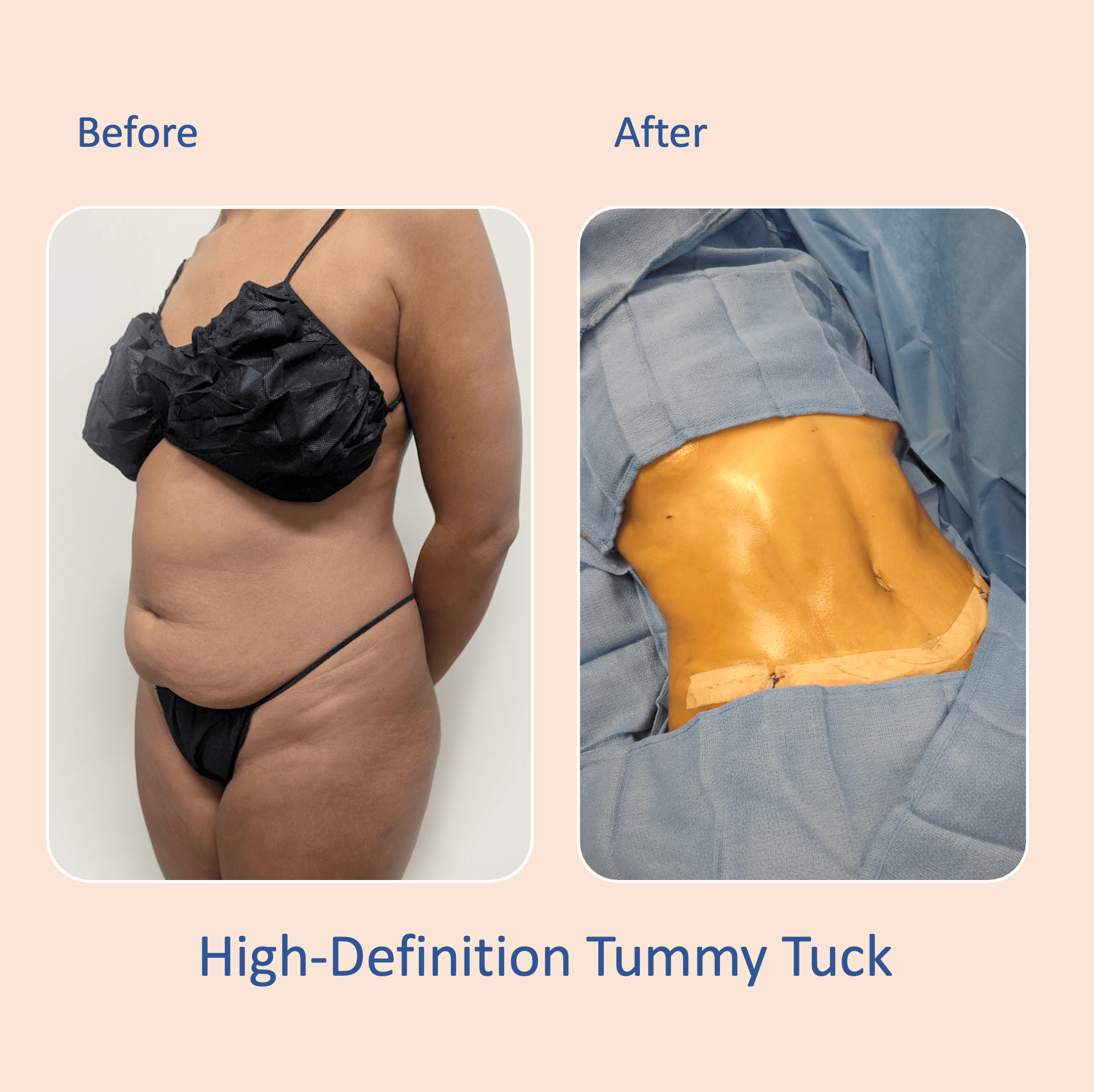 Before & after results of bariatric surgery, gastric sleeve, weight loss surgery, performed by Dr. Vishal Mehta, top bariatric Surgeon serving Central NJ, Princeton, Montgomery, and surrounding areas.