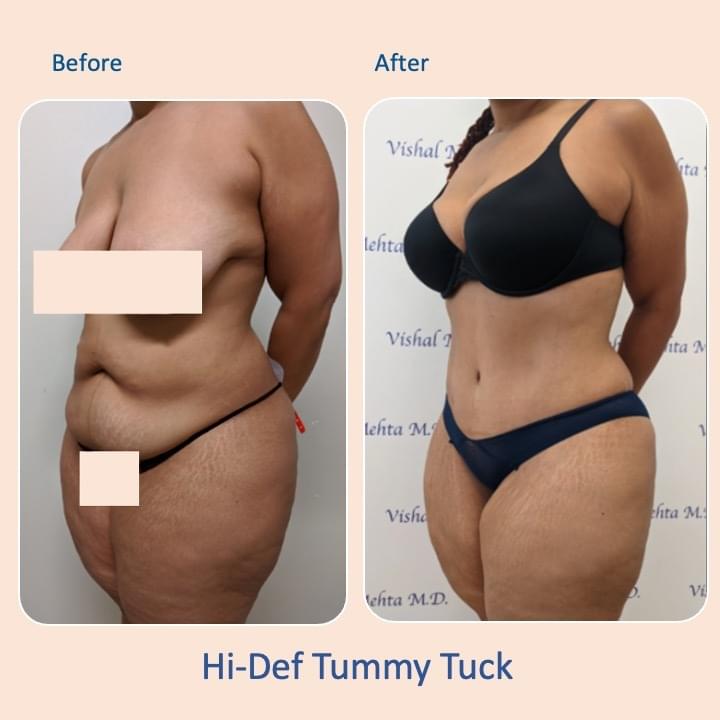 Before & after results of tummy tuck and liposuction, lipo-sculpting performed by Dr. Vishal Mehta, top Liposuction Surgeon serving Central NJ, Princeton, Montgomery, NJ and surrounding areas.