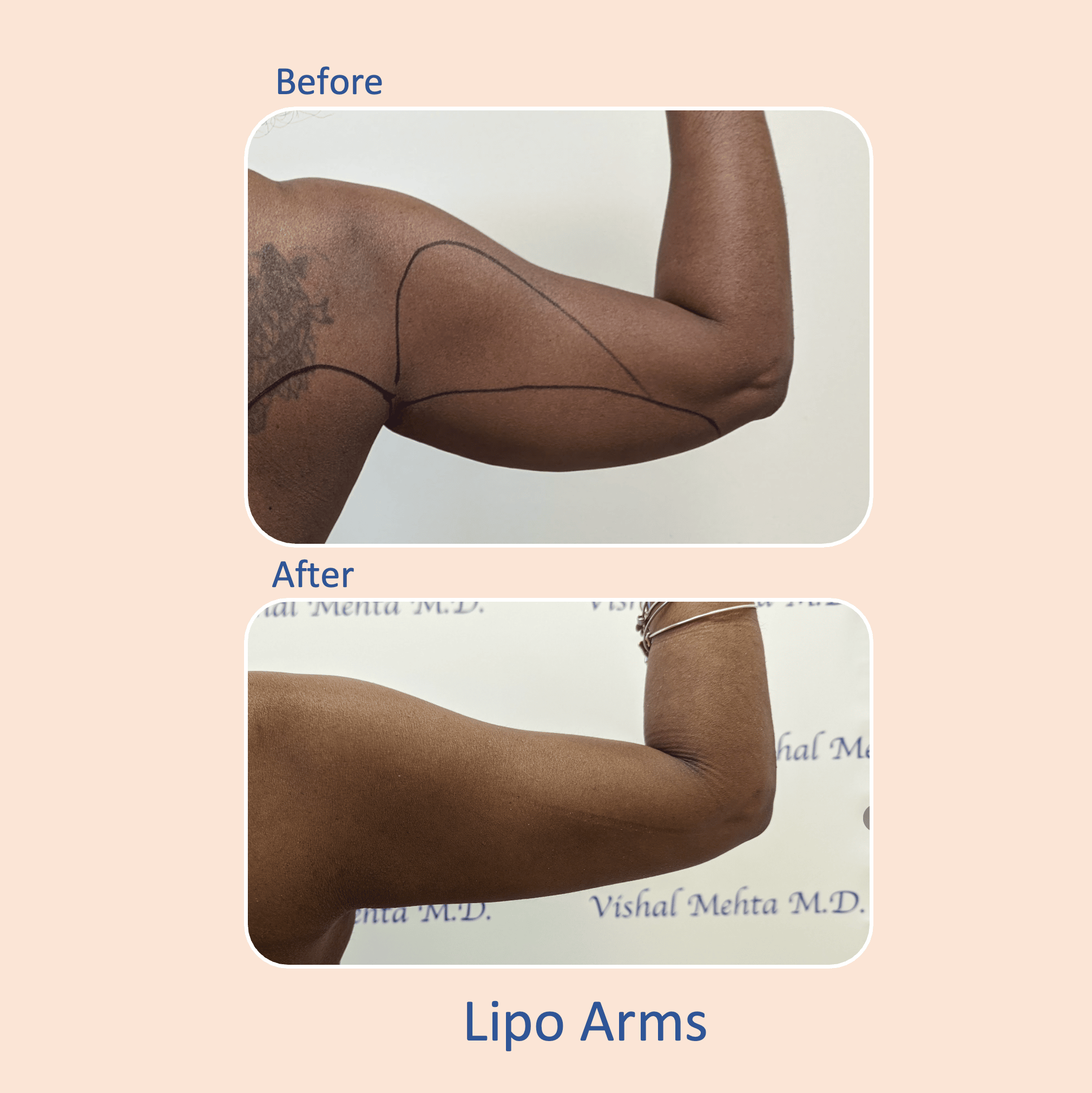 Before & after results of awake liposuction, lipo-sculpting arms performed by Dr. Vishal Mehta, top Liposuction Surgeon, Central NJ