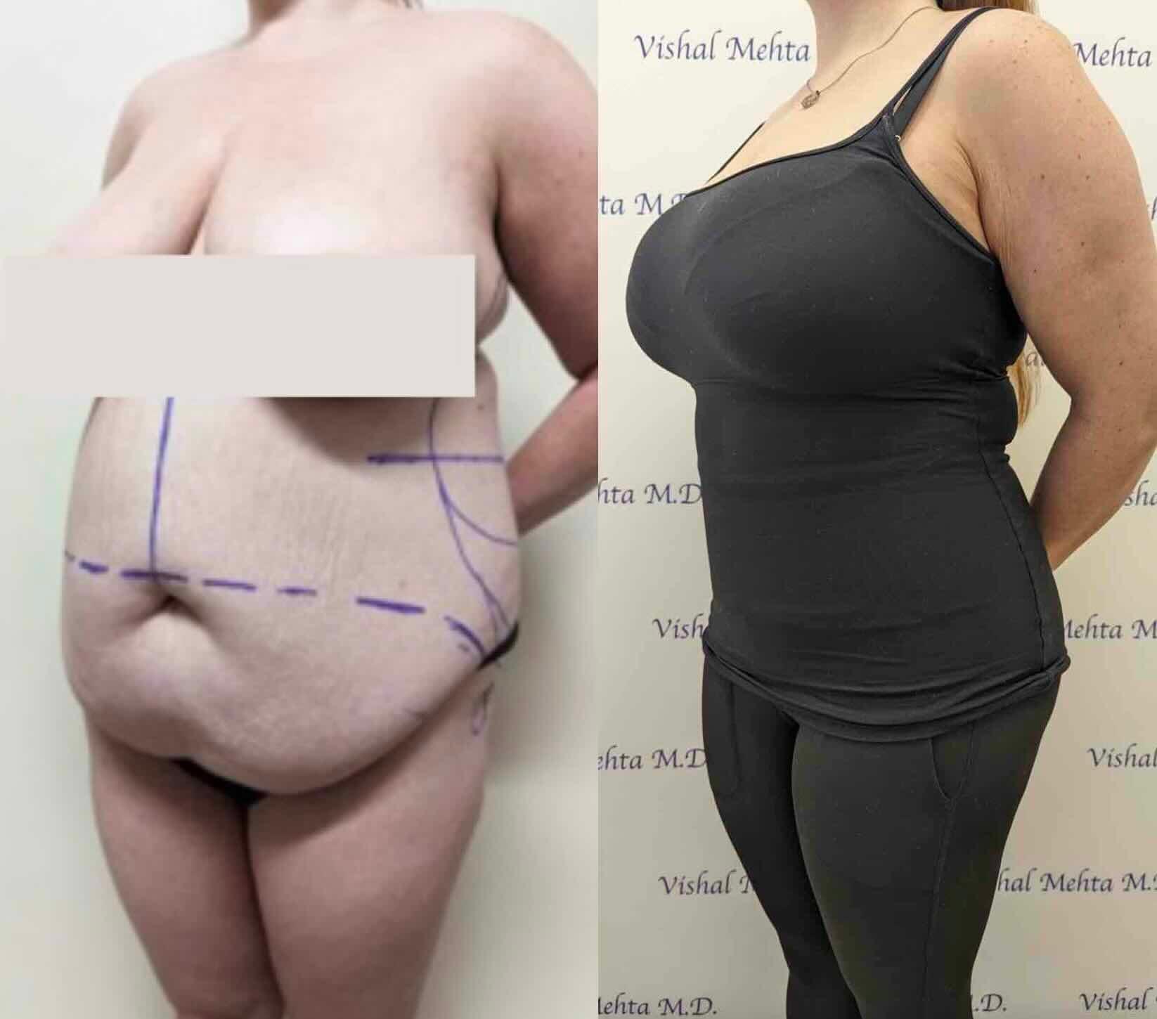 Before & after results of abdominoplasty, tummy tuck, panniculectomy performed by Dr. Vishal Mehta, top bariatric Surgeon serving Central NJ, Princeton, Montgomery, and surrounding areas.