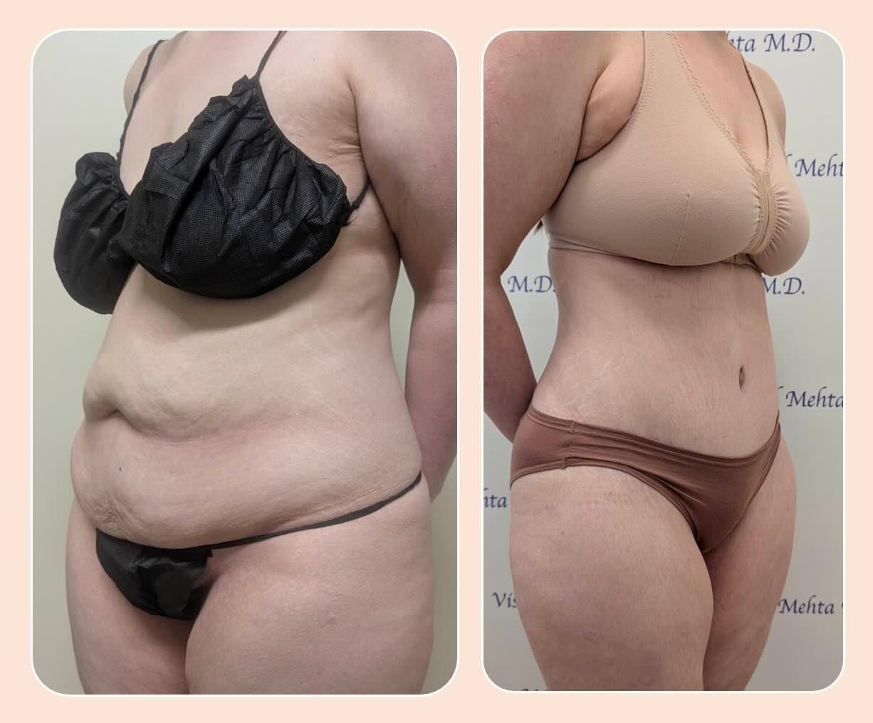 Before & after results of tummy tuck and liposuction, lipo-sculpting performed by Dr. Vishal Mehta, top Liposuction Surgeon serving Central NJ, Princeton, Montgomery, NJ and surrounding areas.