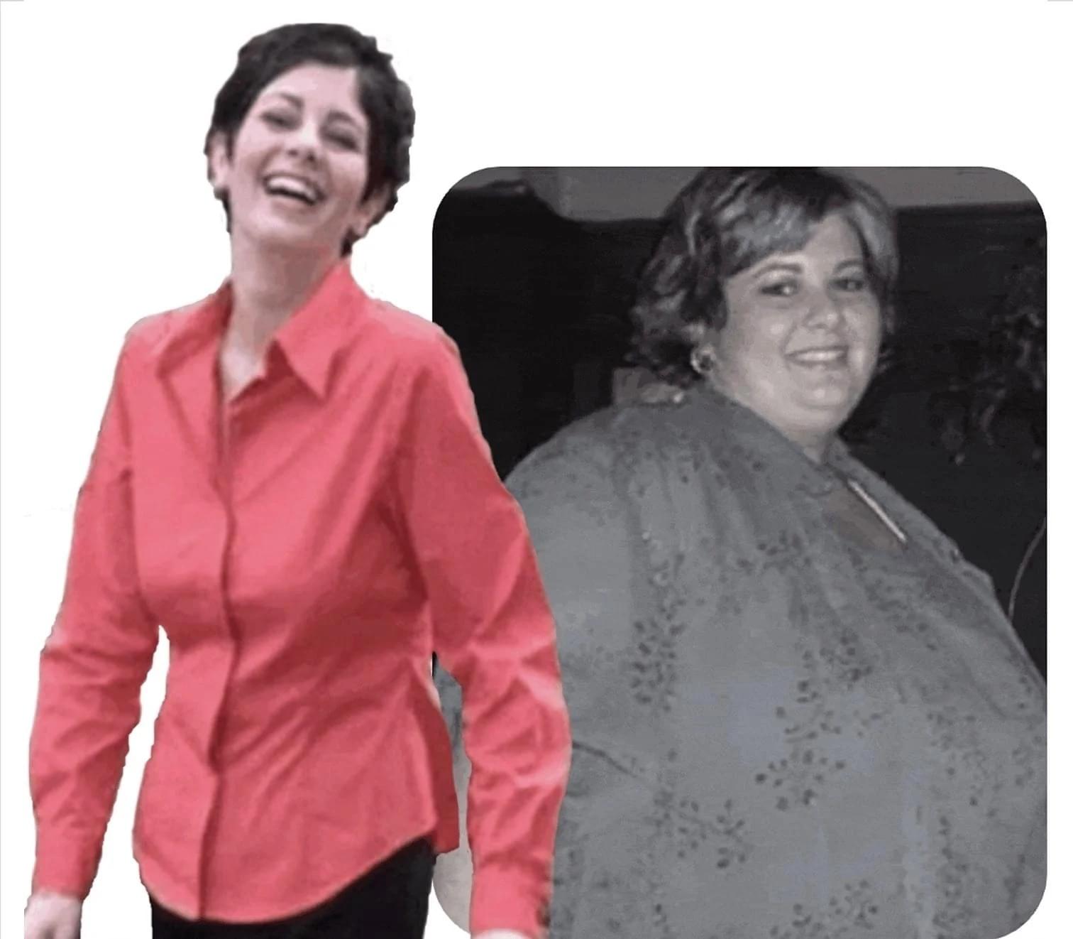 Before & after results of bariatric surgery, gastric sleeve, weight loss surgery, performed by Dr. Vishal Mehta, top bariatric Surgeon serving Central NJ, Princeton, Montgomery, and surrounding areas.