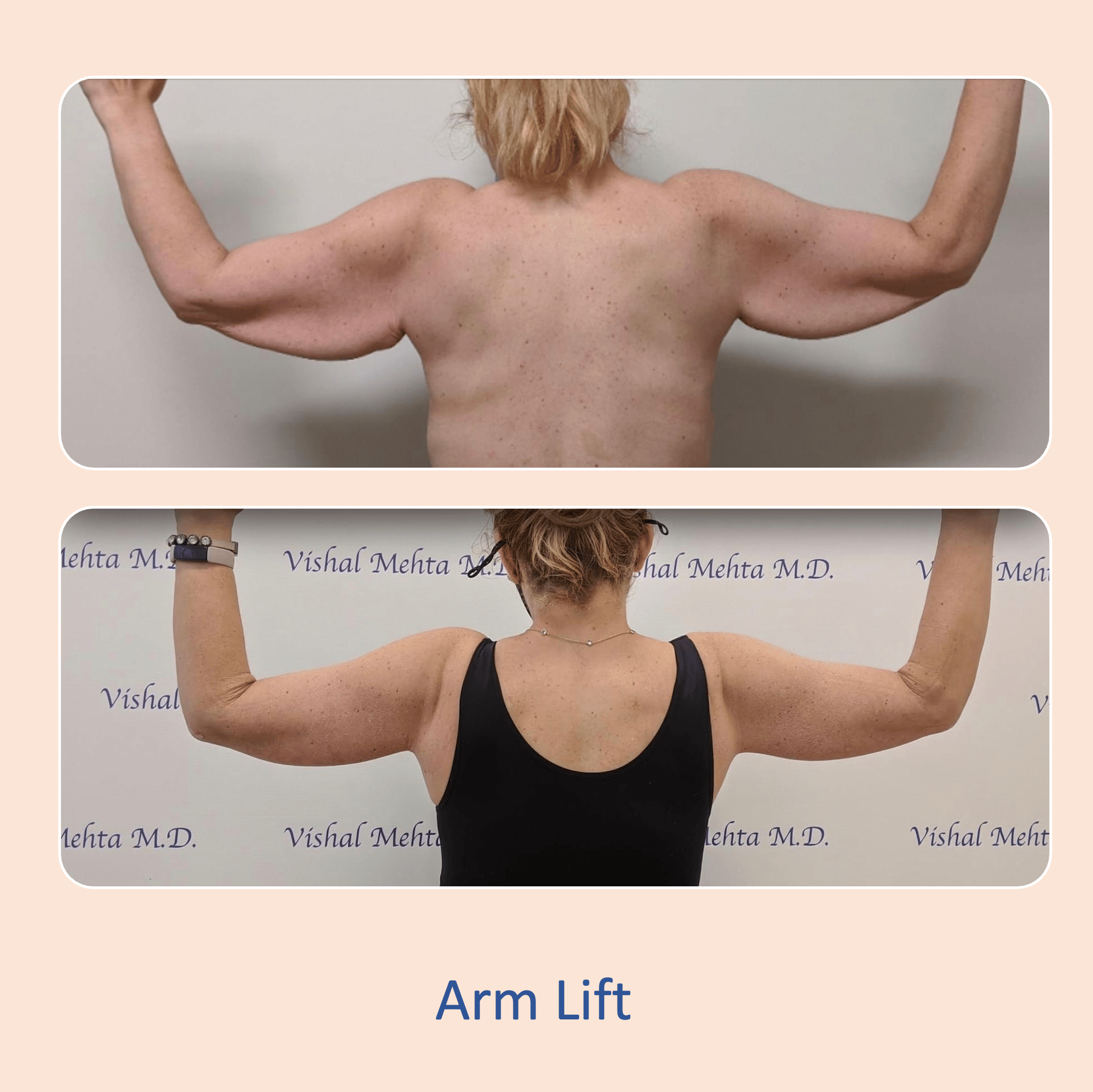 Before & after results of arm lift performed by Dr. Vishal Mehta, top arm lift Surgeon serving Central NJ, Princeton, Montgomery, and surrounding areas.