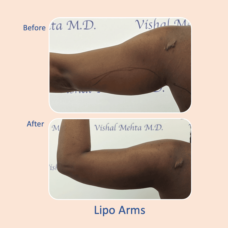 Before & after results of awake liposuction, lipo-sculpting arms performed by Dr. Vishal Mehta, top Liposuction Surgeon, Central NJ