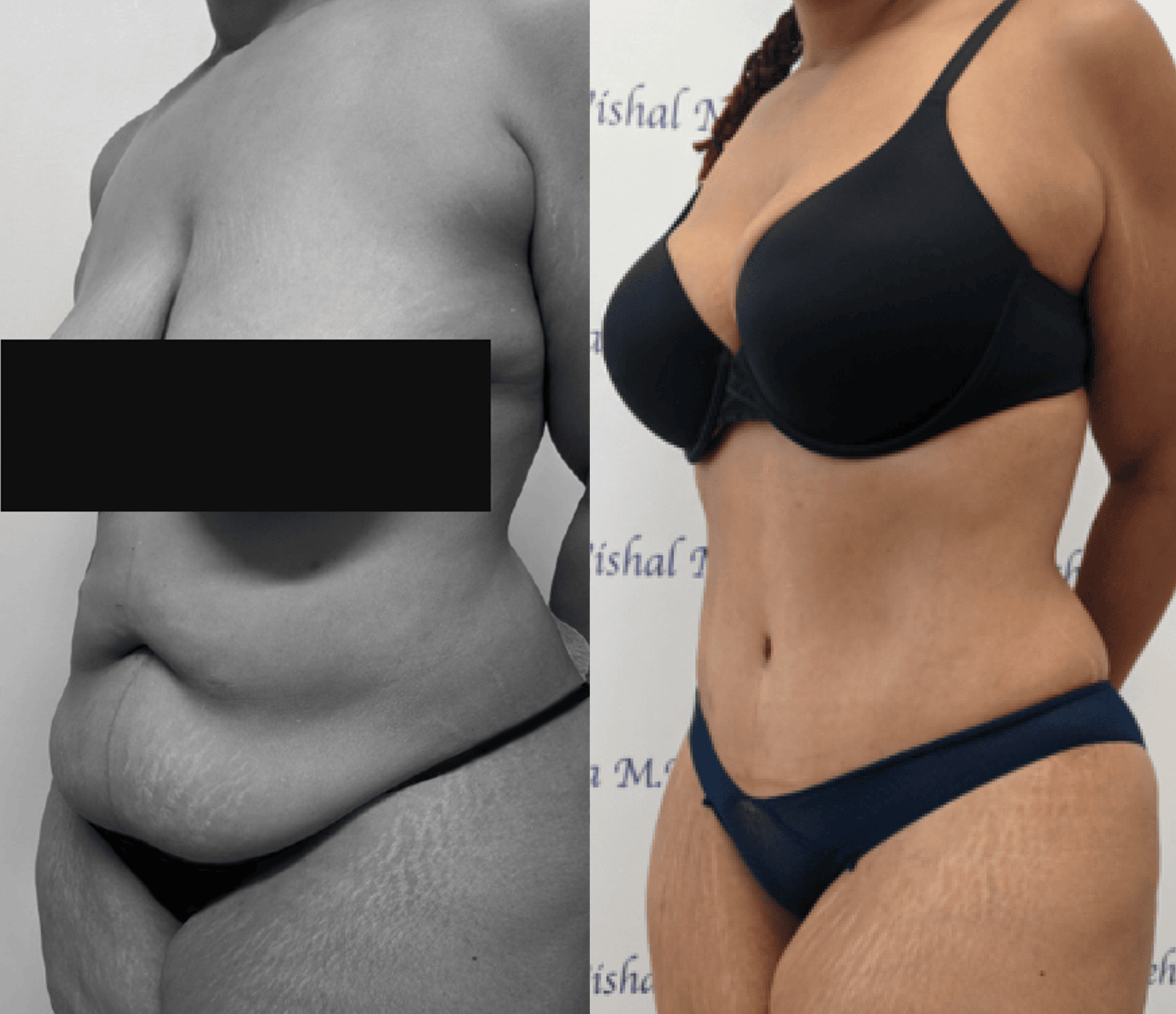 Before & after results of awake liposuction, lipo-sculpting performed by Dr. Vishal Mehta, top Liposuction Surgeon, Central NJ
