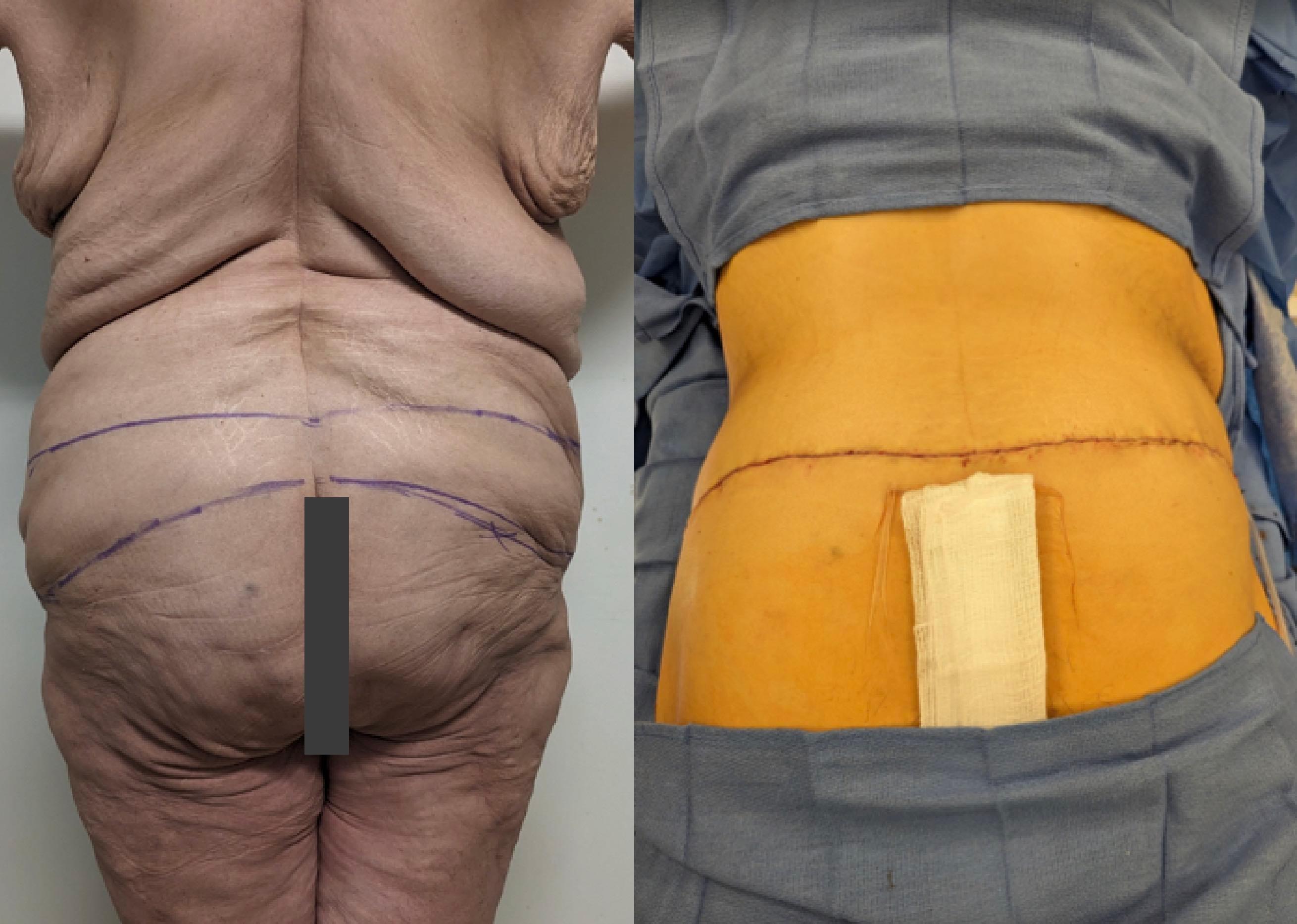 Fat Transfer and Tummy Tuck