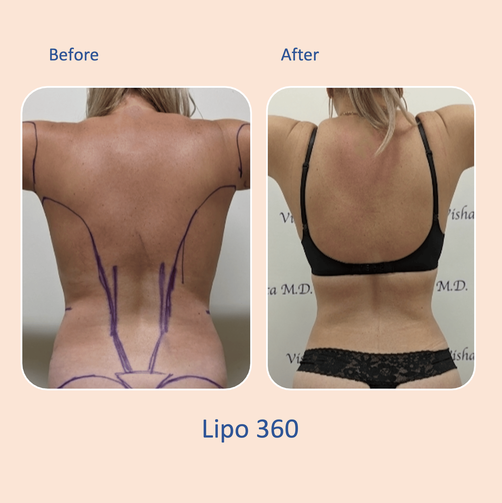 Before & after results of awake liposuction, lipo-sculpting performed by Dr. Vishal Mehta, top Liposuction Surgeon, Central NJ