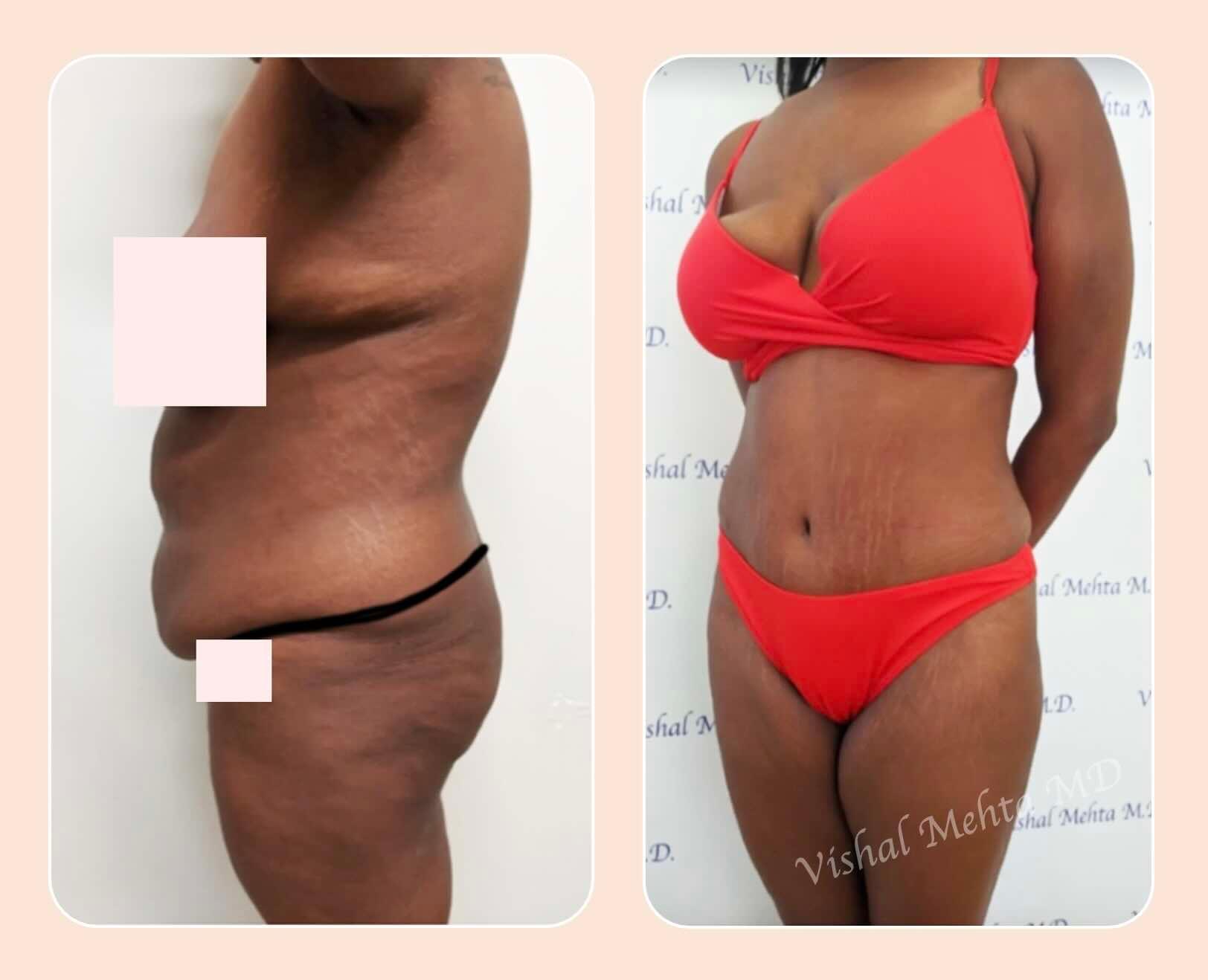 Before & after results of tummy tuck and liposuction, lipo-sculpting performed by Dr. Vishal Mehta, top Liposuction Surgeon serving Central NJ, Princeton, Montgomery, NJ and surrounding areas.