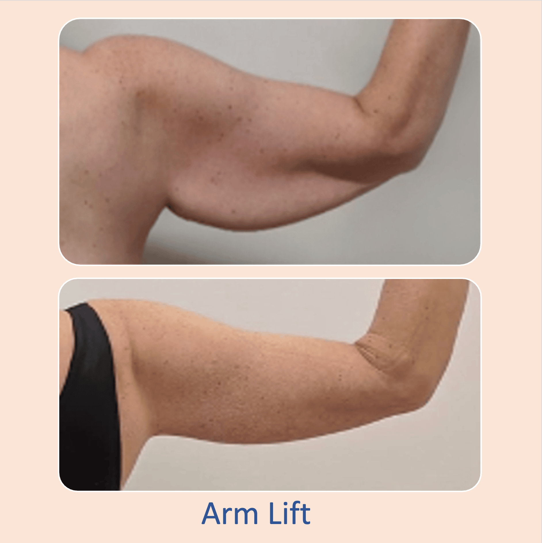Before & after results of arm lift performed by Dr. Vishal Mehta, top arm lift Surgeon serving Central NJ, Princeton, Montgomery, and surrounding areas.
