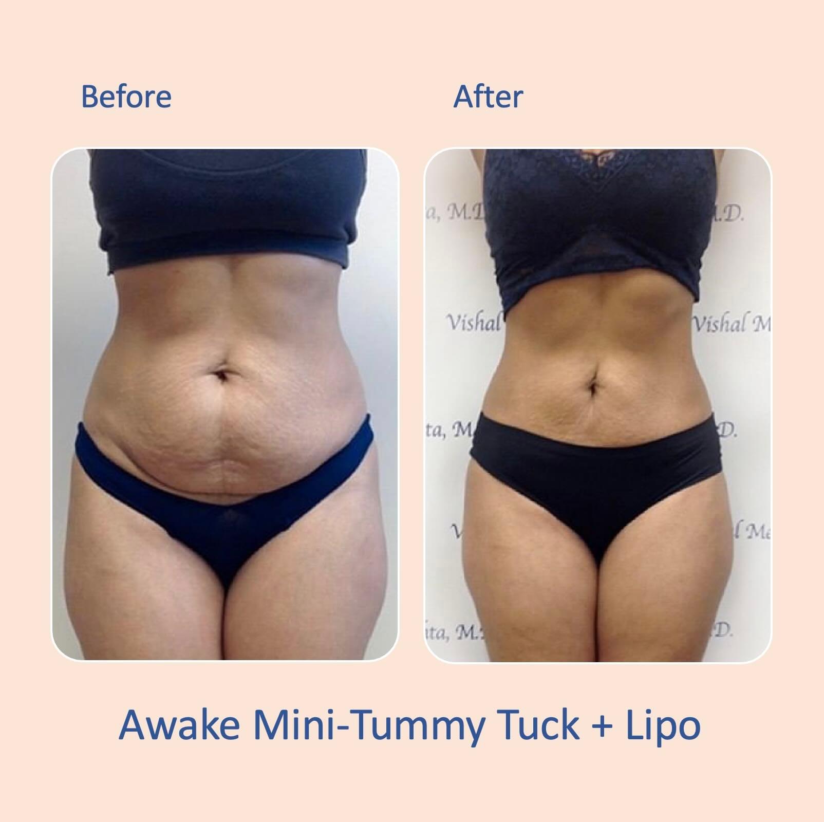 Before & after results of awake mini-tummy tuck and liposuction, lipo-sculpting performed by Dr. Vishal Mehta, top Liposuction Surgeon serving Central NJ, Princeton, Montgomery, and surrounding areas.