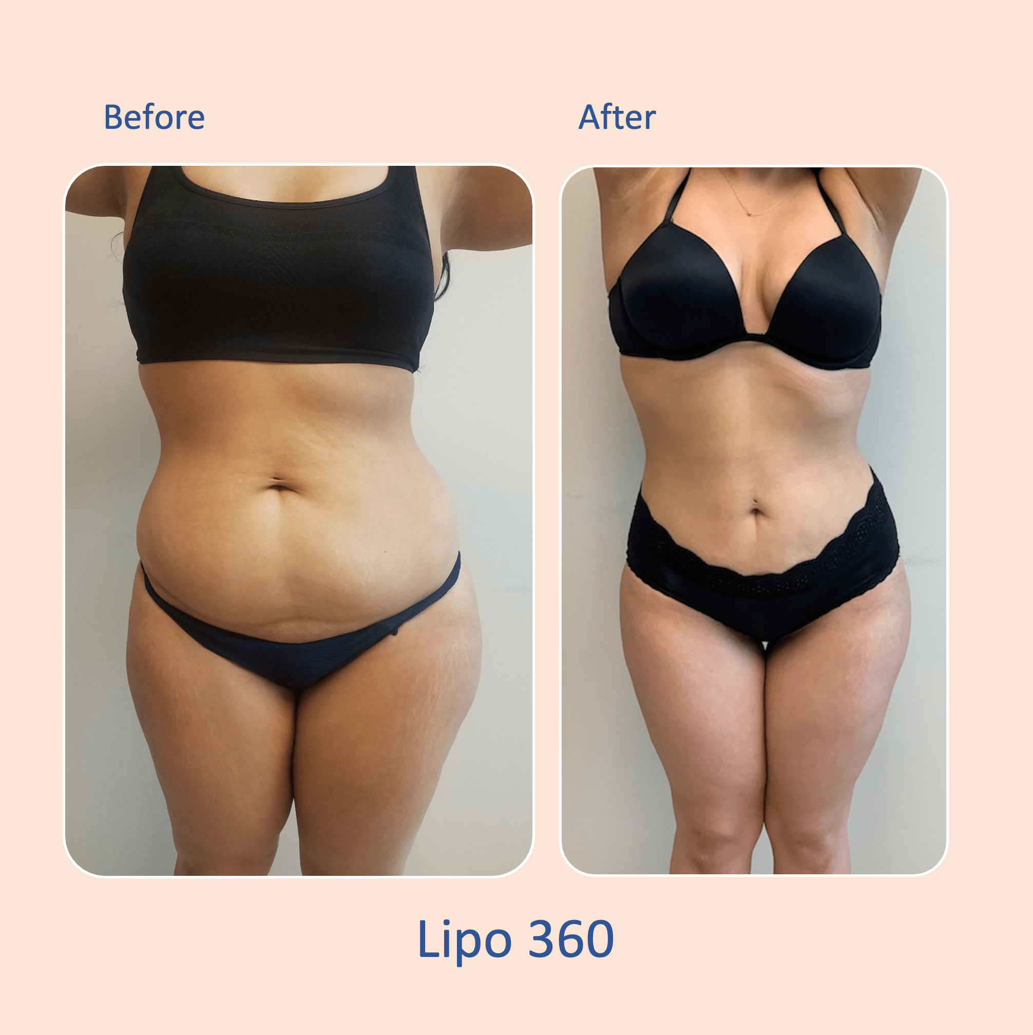 Before & after results of awake liposuction, lipo-sculpting performed by Dr. Vishal Mehta, top Liposuction Surgeon, Central NJ