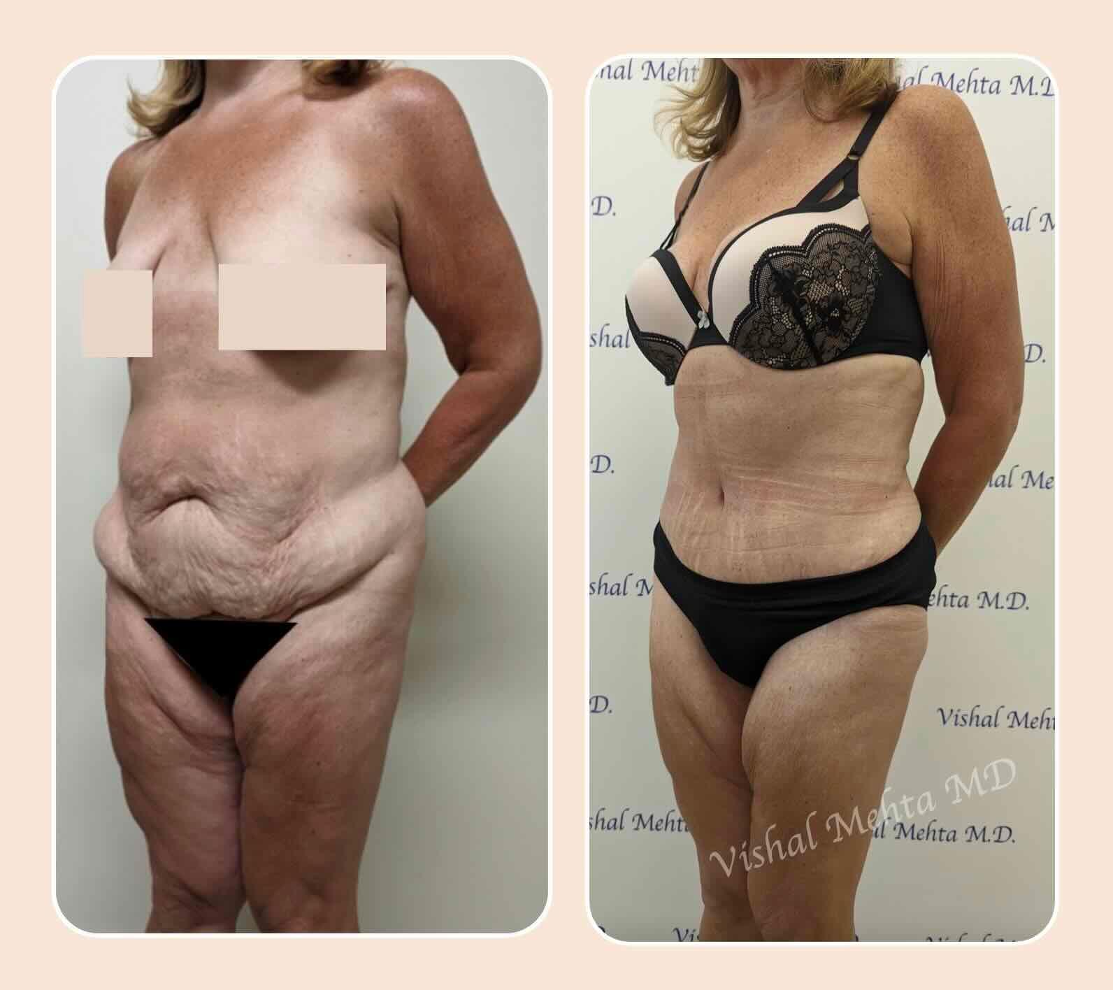 Before & after results of tummy tuck and liposuction, lipo-sculpting performed by Dr. Vishal Mehta, top Liposuction Surgeon serving Central NJ, Princeton, Montgomery, NJ and surrounding areas.
