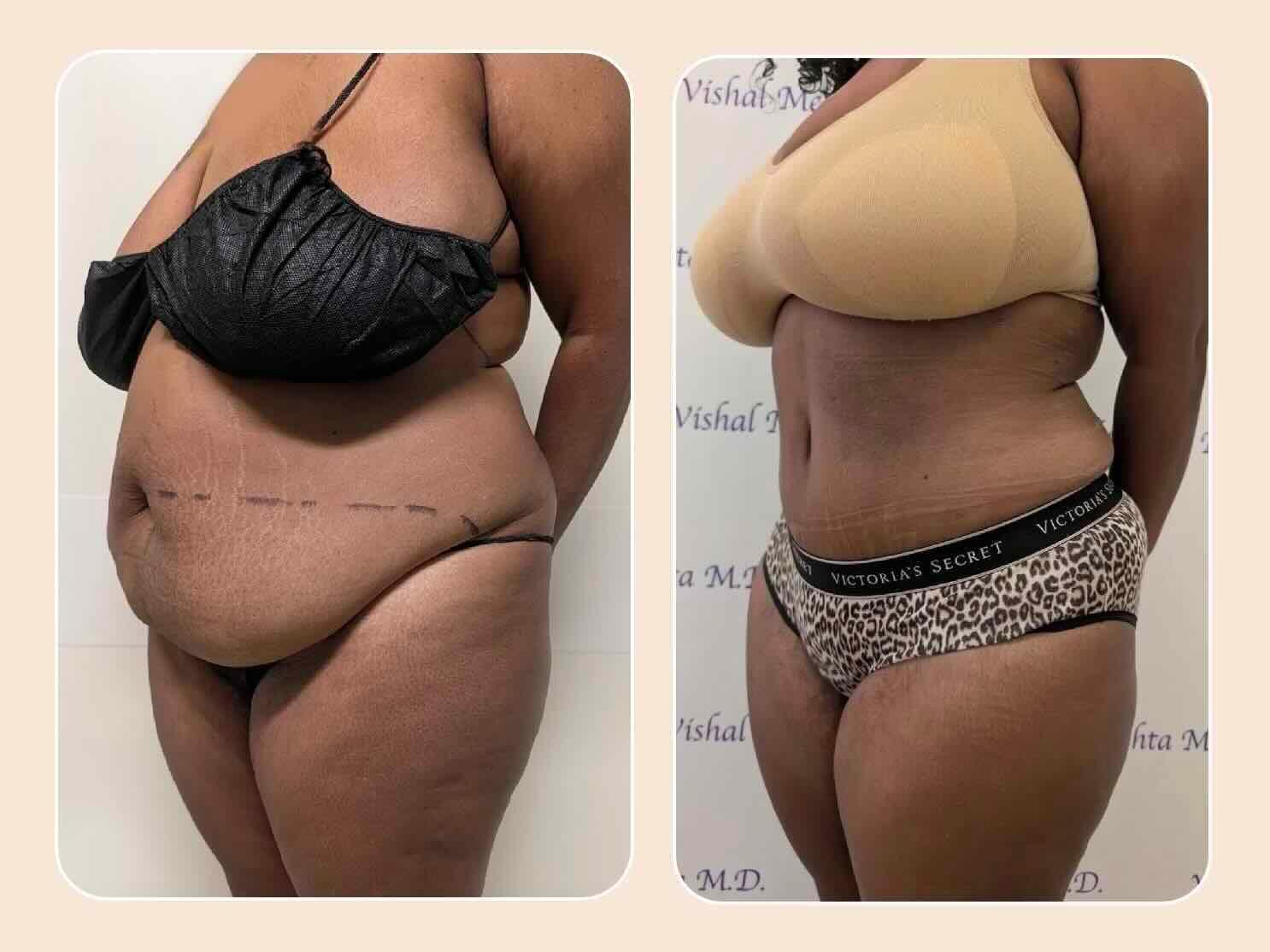 Before & after results of abdominoplasty, tummy tuck, panniculectomy performed by Dr. Vishal Mehta, top bariatric Surgeon serving Central NJ, Princeton, Montgomery, and surrounding areas.