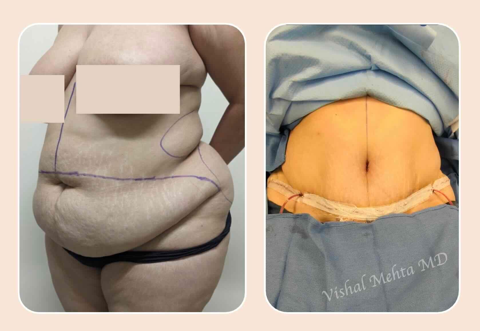 Before & after results of abdominoplasty, tummy tuck, panniculectomy performed by Dr. Vishal Mehta, top bariatric Surgeon serving Central NJ, Princeton, Montgomery, and surrounding areas.
