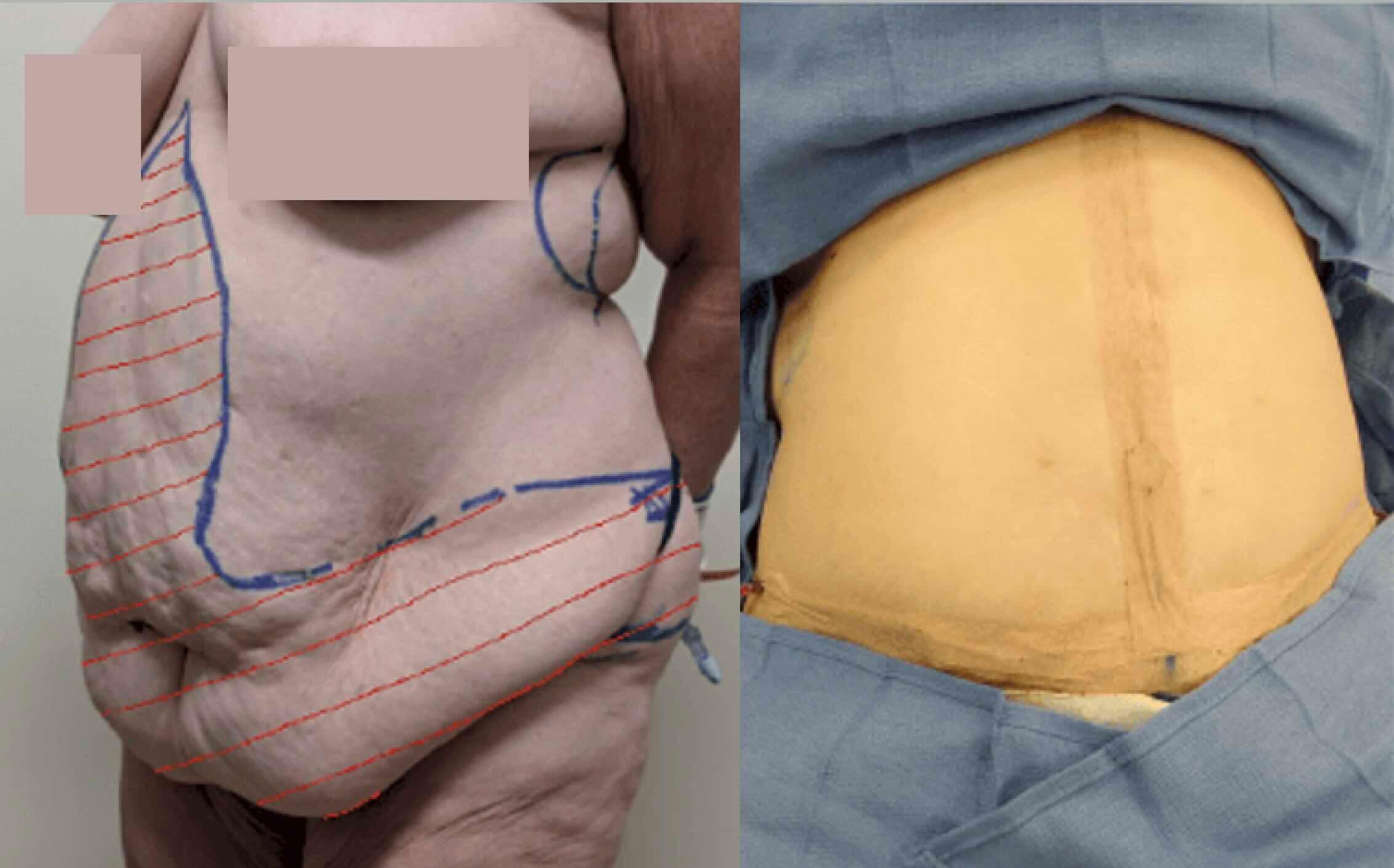 Before & after results of awake liposuction, lipo-sculpting performed by Dr. Vishal Mehta, top Liposuction Surgeon, Central NJ