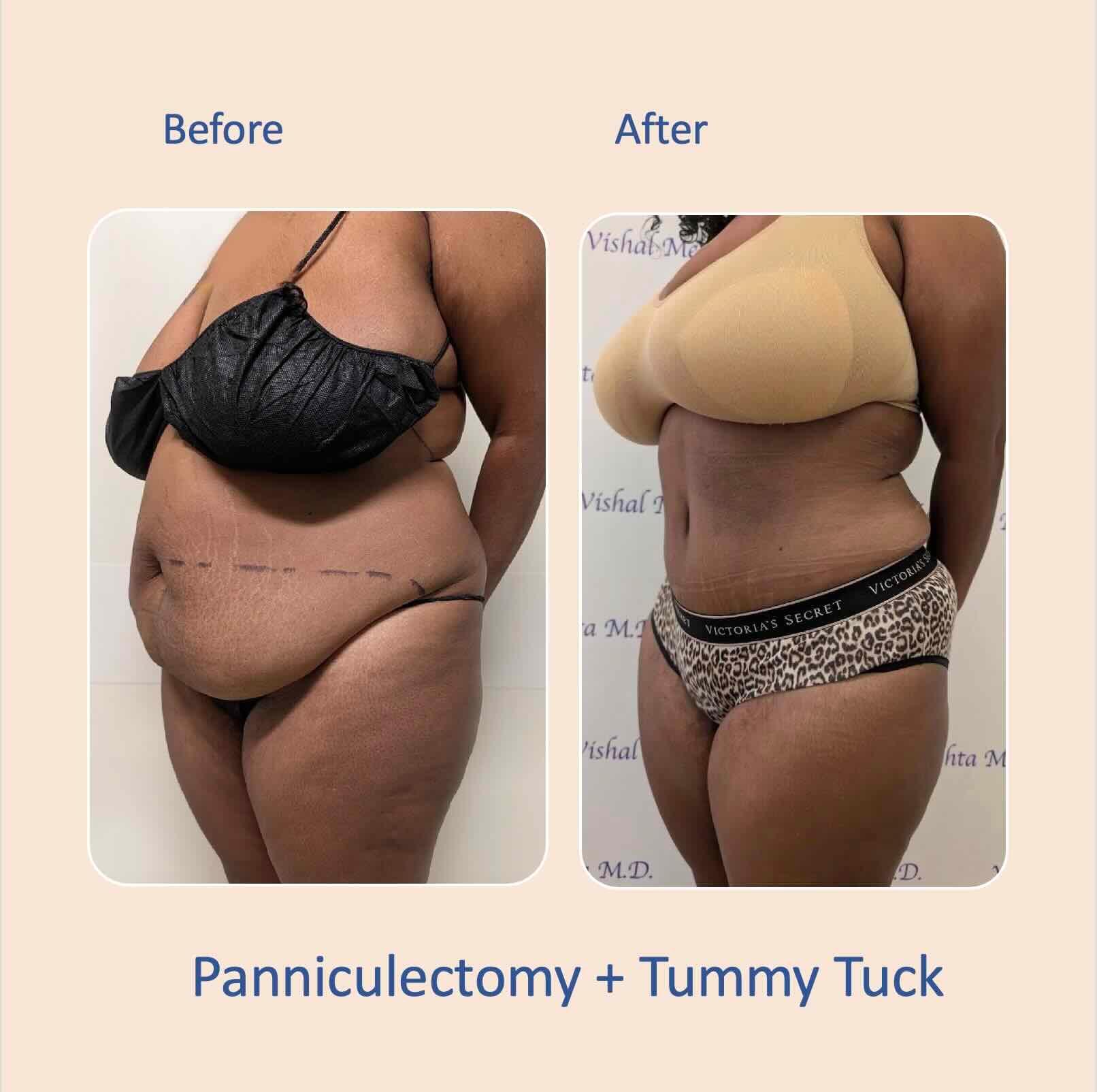 Before & after results of abdominoplasty, tummy tuck, panniculectomy performed by Dr. Vishal Mehta, top bariatric Surgeon serving Central NJ, Princeton, Montgomery, and surrounding areas.