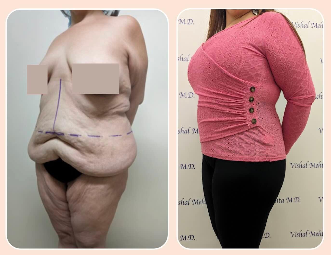 Before & after results of male, men, abdominoplasty, tummy tuck, panniculectomy performed by Dr. Vishal Mehta, top bariatric Surgeon serving Central NJ, Princeton, Montgomery, and surrounding areas.