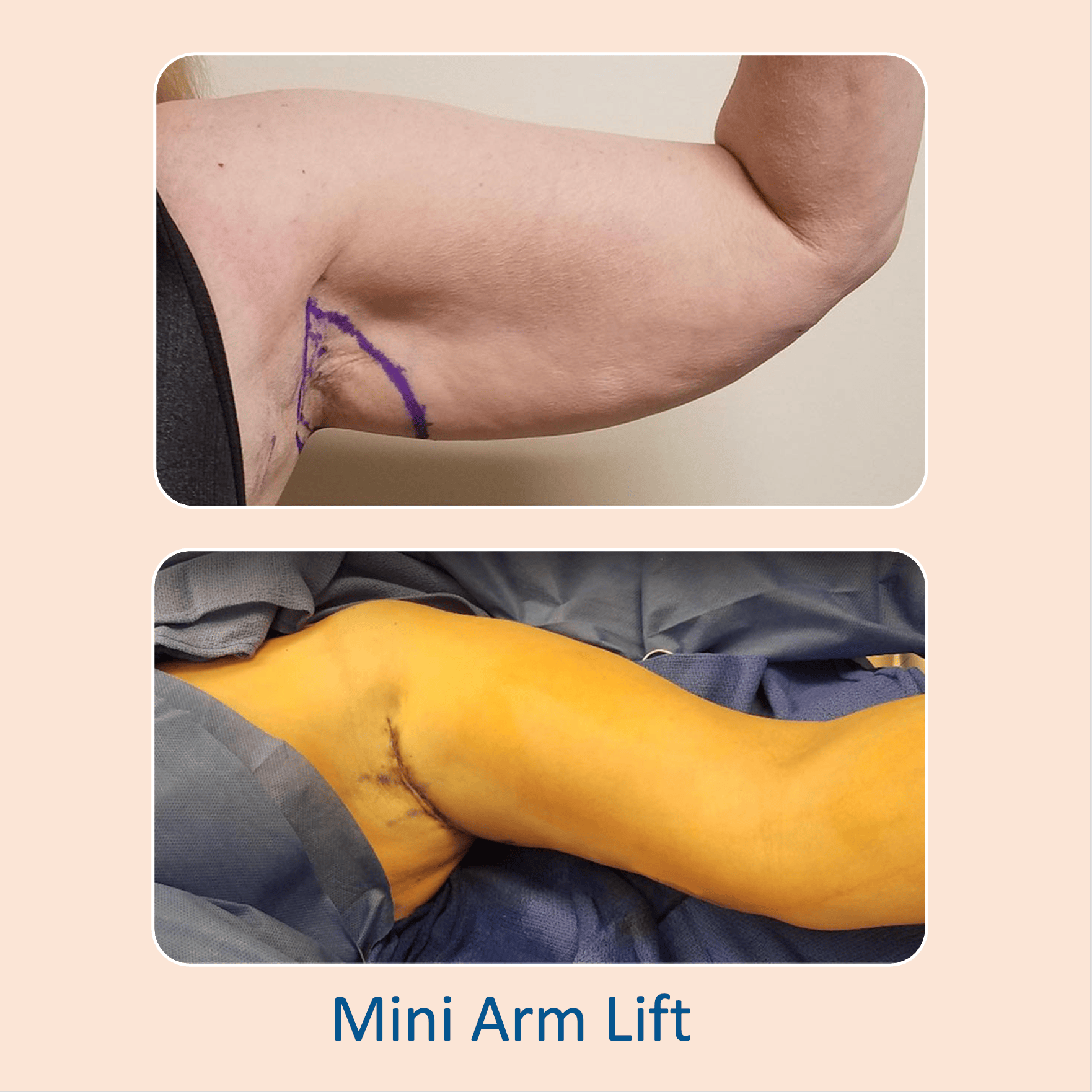 Before & after results of mini-arm lift performed by Dr. Vishal Mehta, top arm lift Surgeon serving Central NJ, Princeton, Montgomery, and surrounding areas.