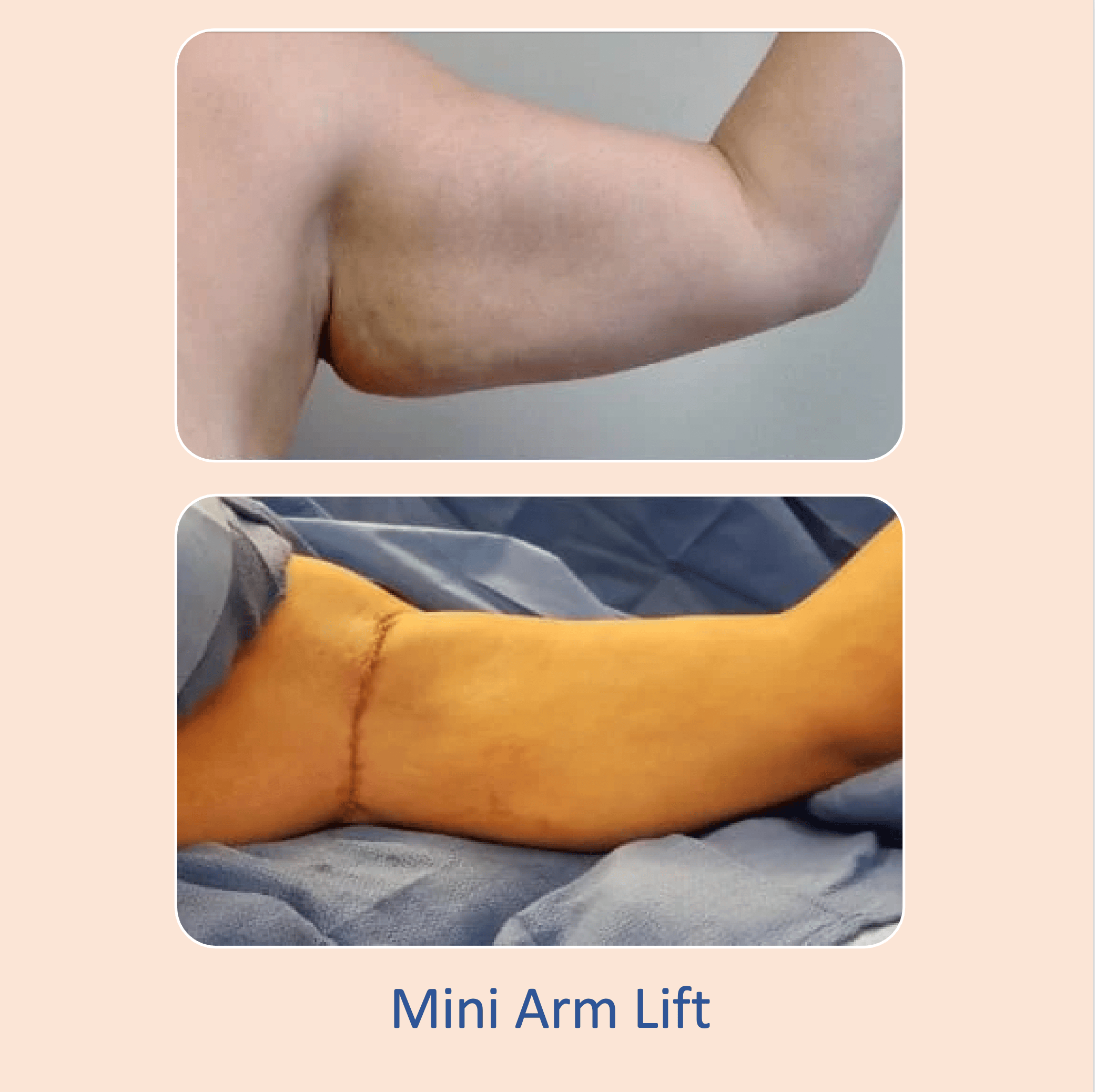 Before & after results of mini-arm lift performed by Dr. Vishal Mehta, top arm lift Surgeon serving Central NJ, Princeton, Montgomery, and surrounding areas.
