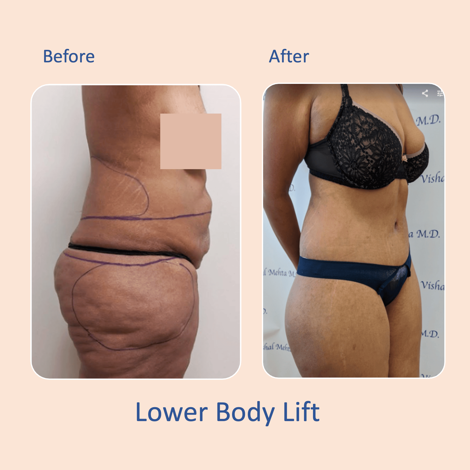 Before & after results of awake liposuction, lipo-sculpting performed by Dr. Vishal Mehta, top Liposuction Surgeon, Central NJ