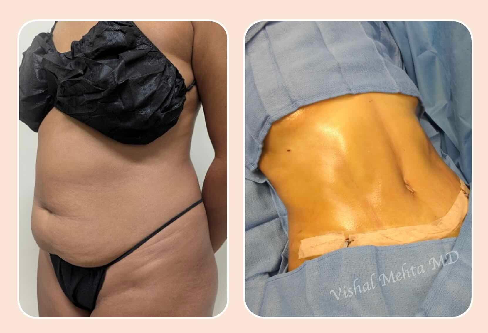 Before & after results of tummy tuck and liposuction, lipo-sculpting performed by Dr. Vishal Mehta, top Liposuction Surgeon serving Central NJ, Princeton, Montgomery, NJ and surrounding areas.