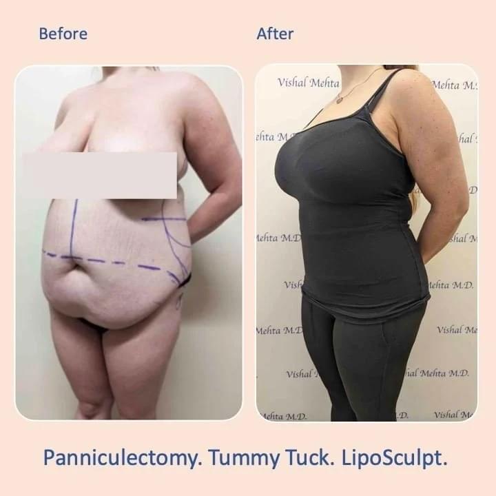 Before & after results of abdominoplasty, tummy tuck, panniculectomy performed by Dr. Vishal Mehta, top bariatric Surgeon serving Central NJ, Princeton, Montgomery, and surrounding areas.