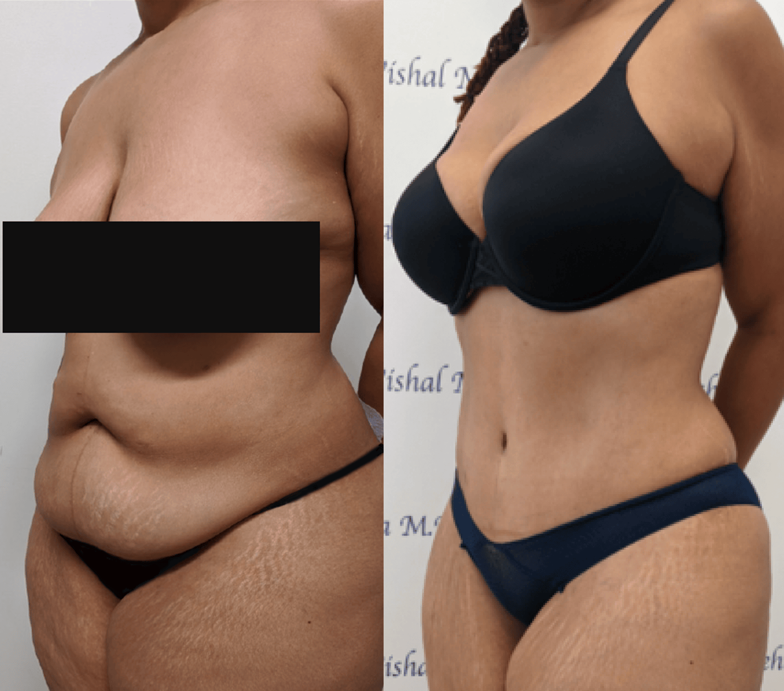 Before & after results of bariatric surgery, gastric sleeve, weight loss surgery, performed by Dr. Vishal Mehta, top bariatric Surgeon serving Central NJ, Princeton, Montgomery, and surrounding areas.