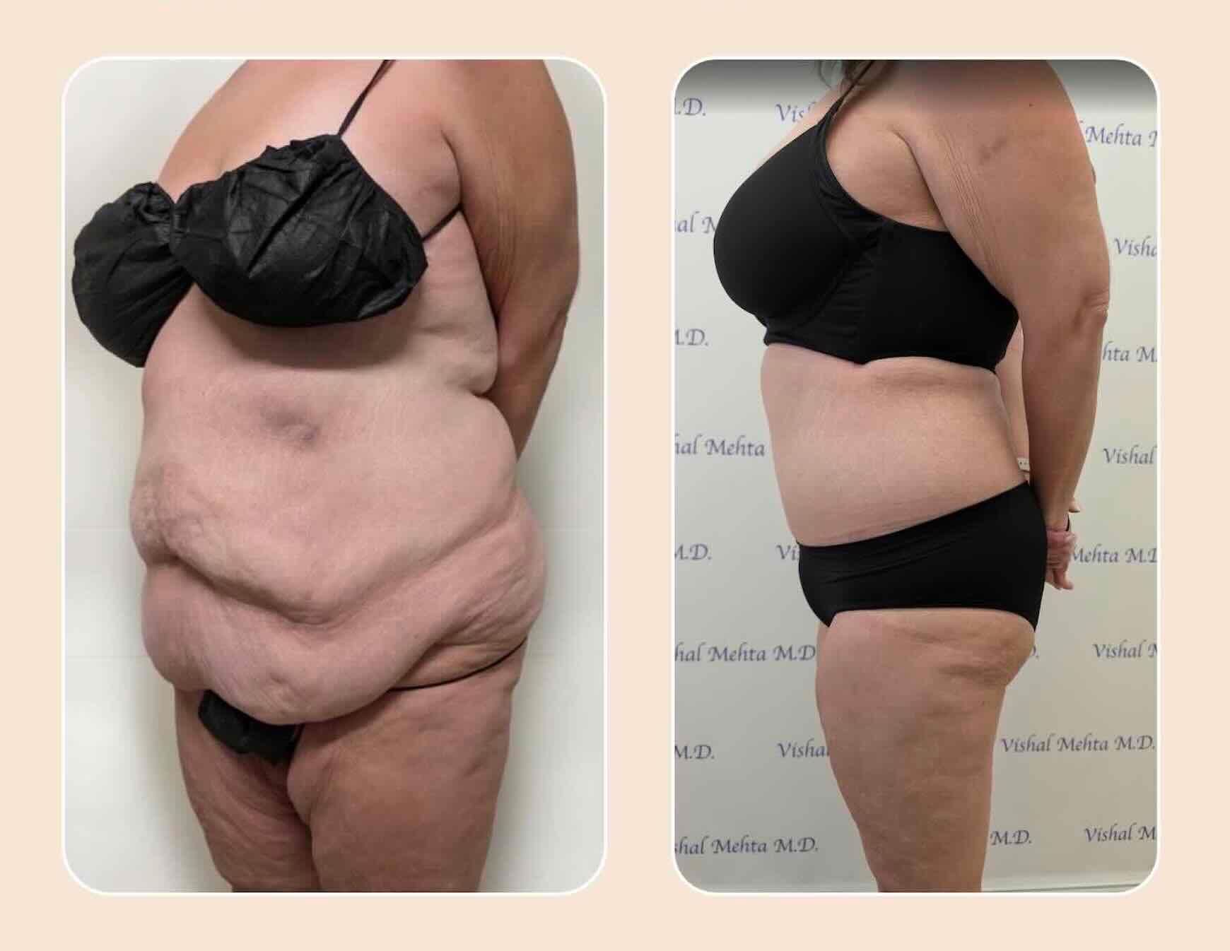Before & after results of abdominoplasty, tummy tuck, panniculectomy performed by Dr. Vishal Mehta, top bariatric Surgeon serving Central NJ, Princeton, Montgomery, and surrounding areas.