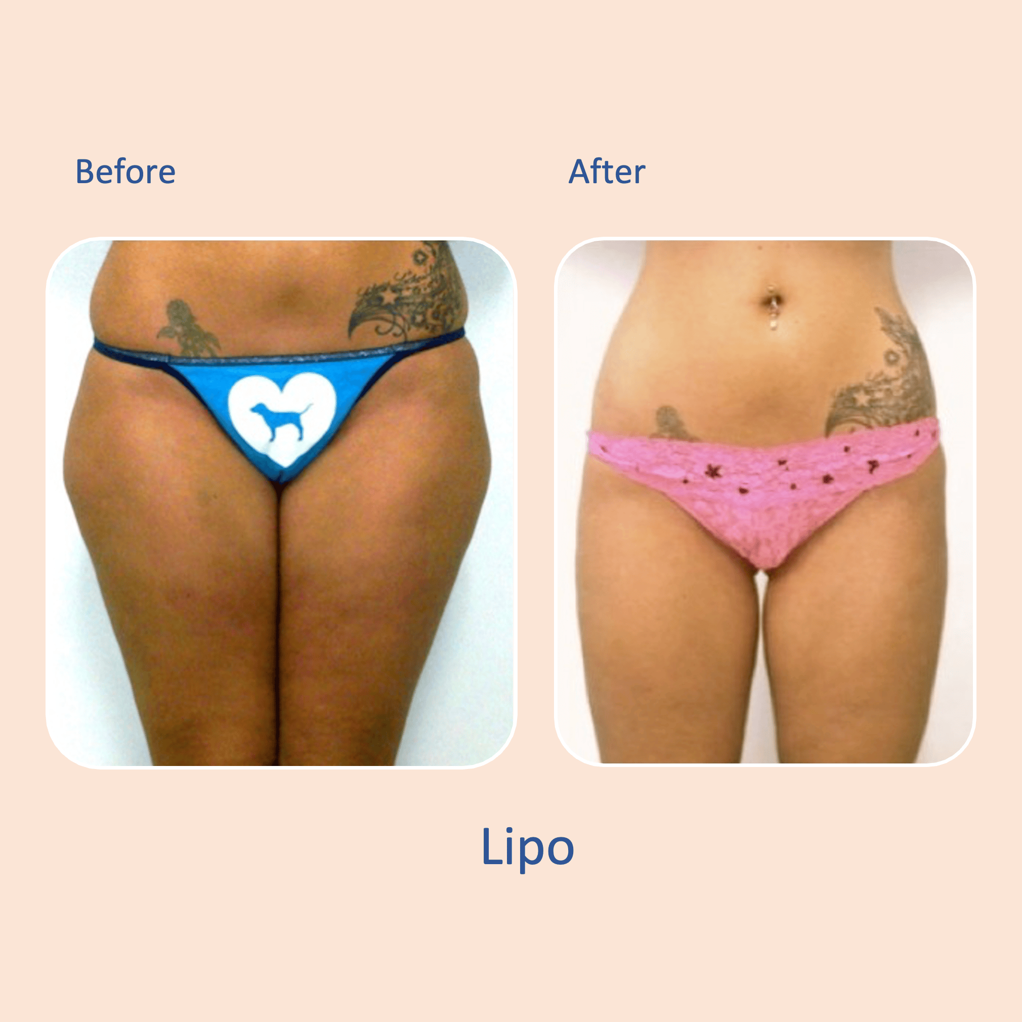 Before & after results of awake liposuction, lipo-sculpting thighs performed by Dr. Vishal Mehta, top Liposuction Surgeon, Central NJ