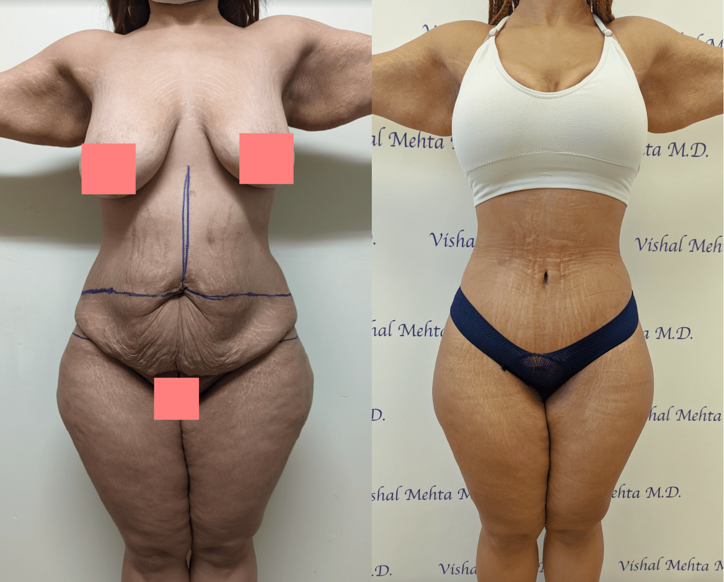 Lower Body Lift vs Tummy Tuck