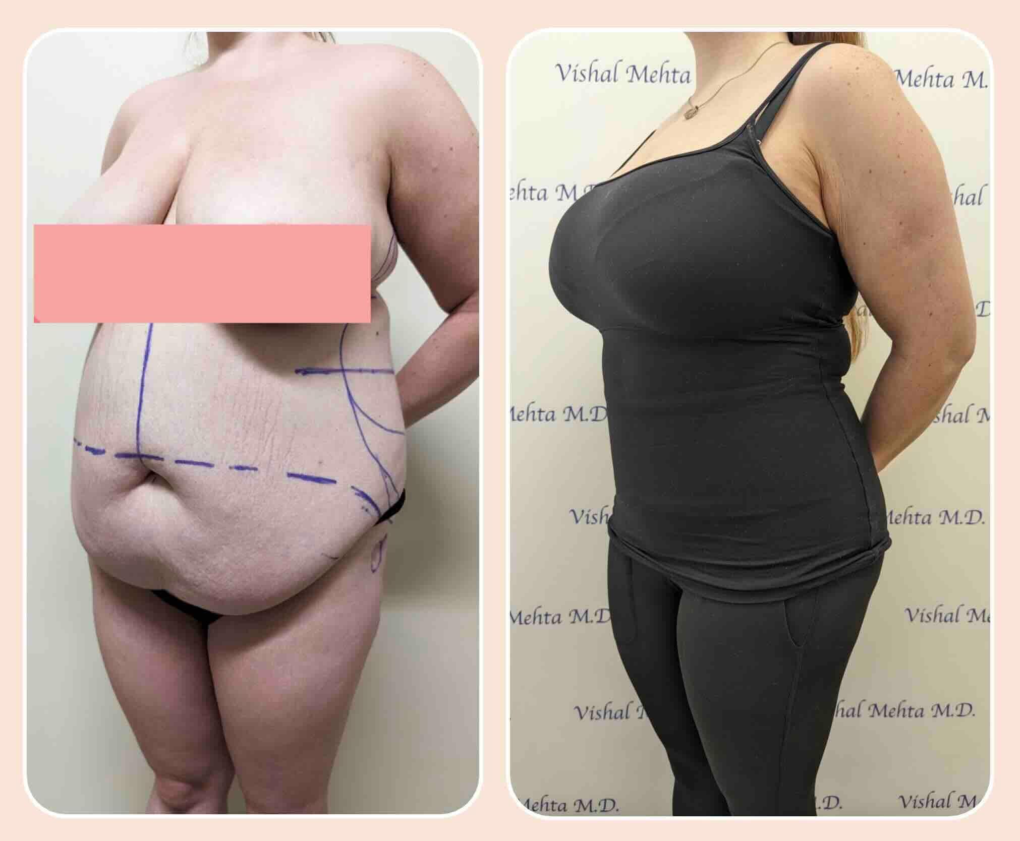 Before & after results of abdominoplasty, tummy tuck, panniculectomy performed by Dr. Vishal Mehta, top bariatric Surgeon serving Central NJ, Princeton, Montgomery, and surrounding areas.