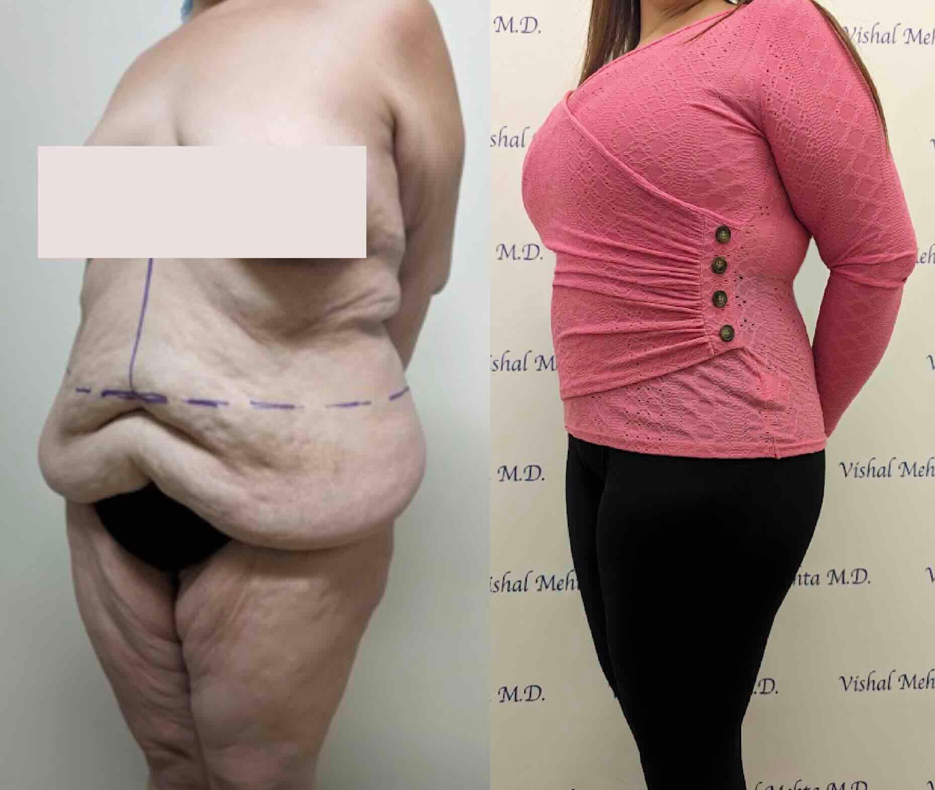 Before & after results of awake liposuction, lipo-sculpting performed by Dr. Vishal Mehta, top Liposuction Surgeon, Central NJ