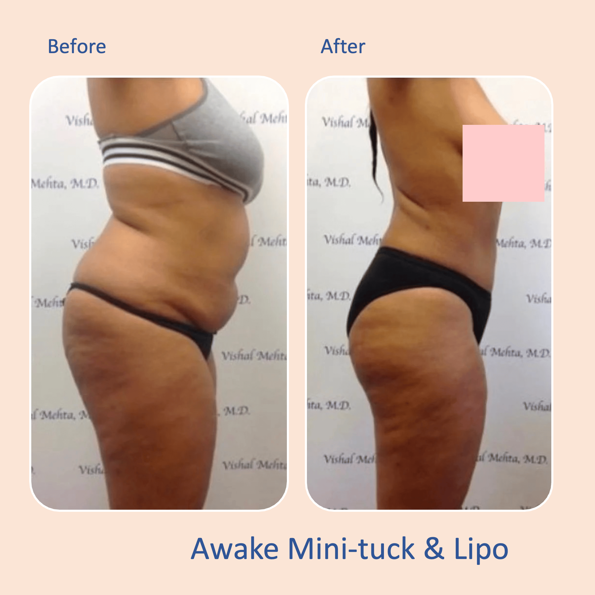 Before & after results of awake mini-tummy tuck and liposuction, lipo-sculpting performed by Dr. Vishal Mehta, top Liposuction Surgeon, Central NJ