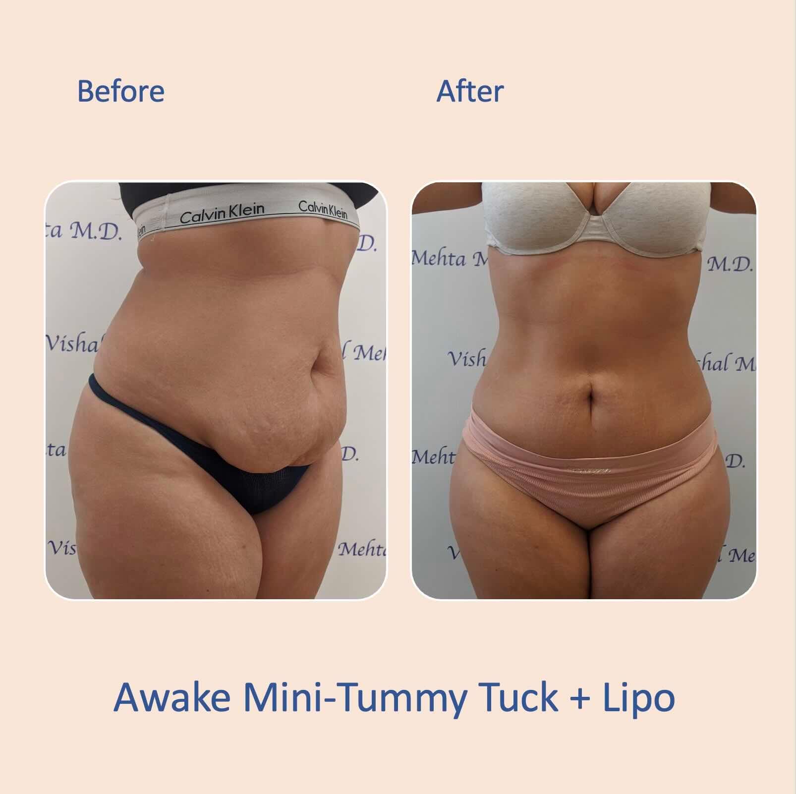 Before & after results of awake mini-tummy tuck and liposuction, lipo-sculpting performed by Dr. Vishal Mehta, top Liposuction Surgeon serving Central NJ, Princeton, Montgomery, and surrounding areas.