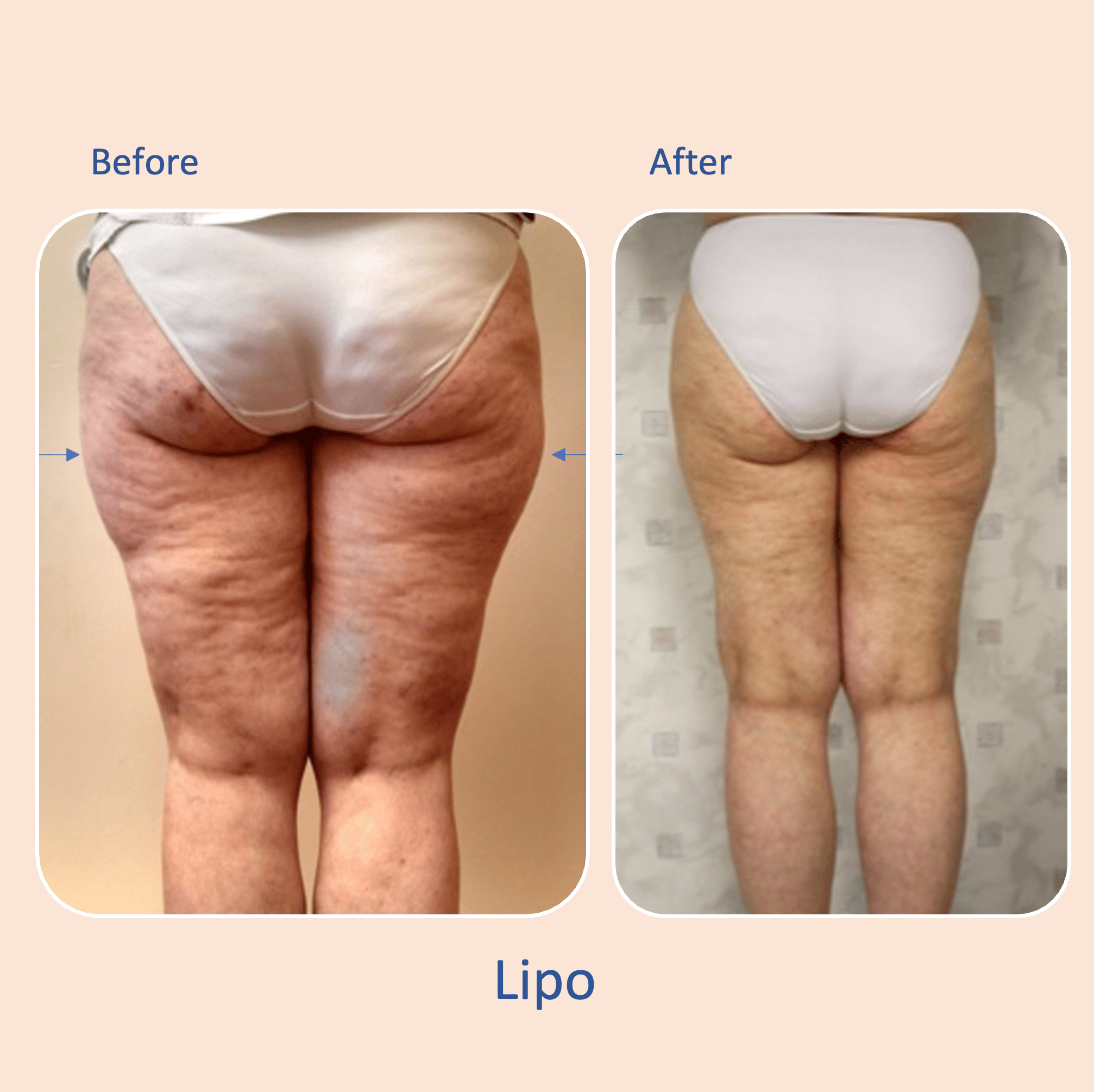 Before & after results of awake liposuction, lipo-sculpting lipedema treatment performed by Dr. Vishal Mehta, top Liposuction Surgeon, Central NJ