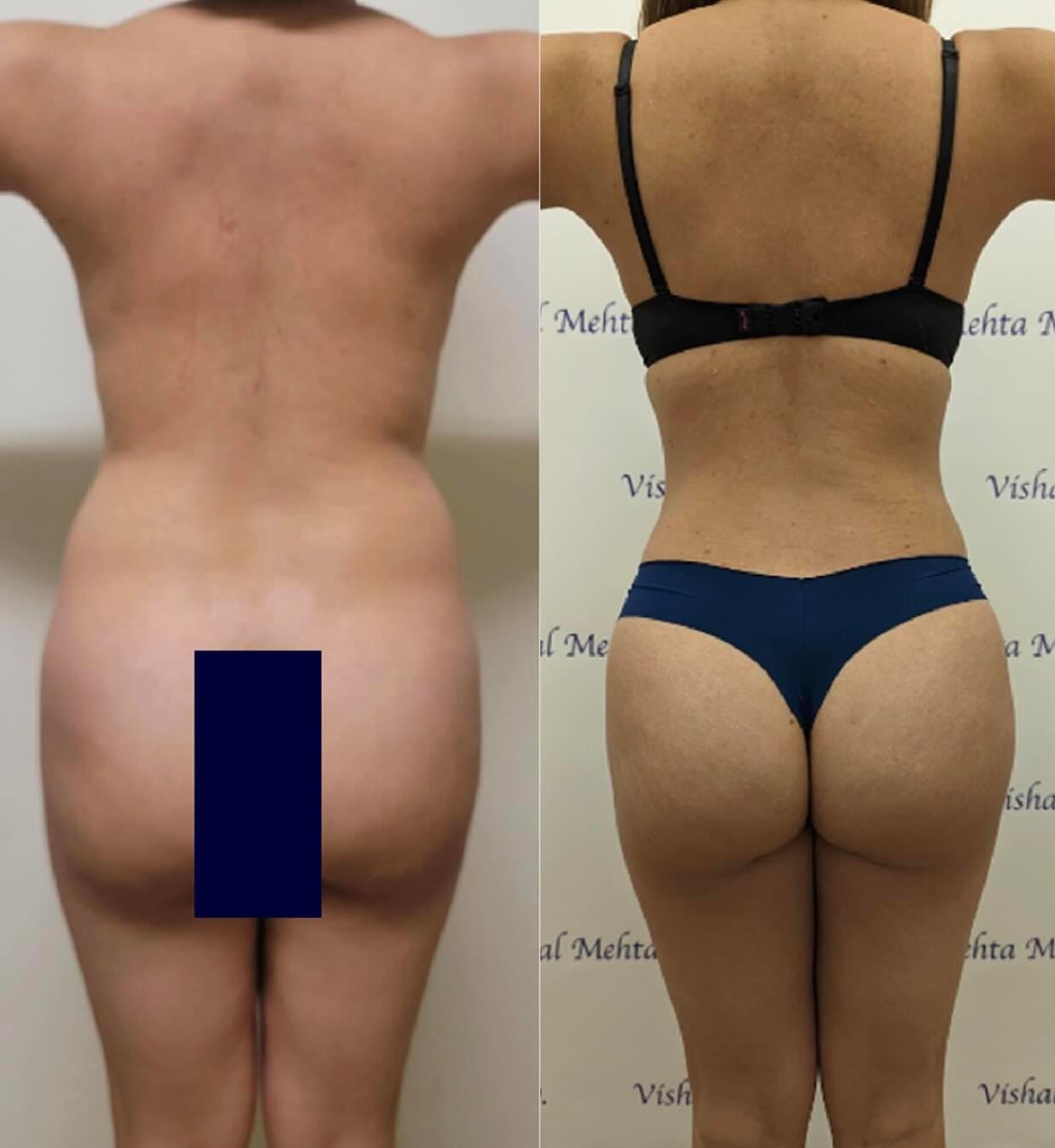 Before & after results of bariatric surgery, gastric sleeve, weight loss surgery, performed by Dr. Vishal Mehta, top bariatric Surgeon serving Central NJ, Princeton, Montgomery, and surrounding areas.