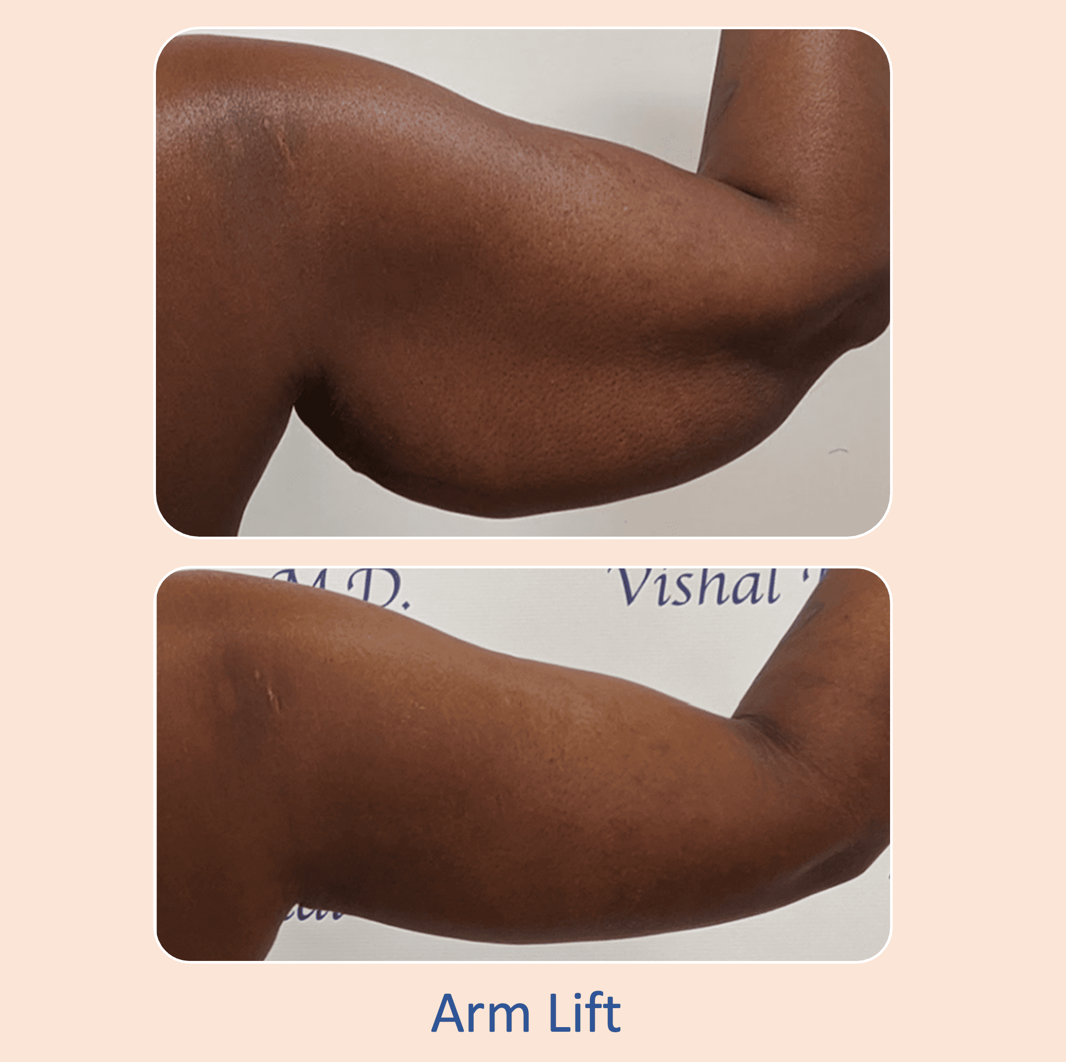 Before & after results of arm lift performed by Dr. Vishal Mehta, top arm lift Surgeon serving Central NJ, Princeton, Montgomery, and surrounding areas.