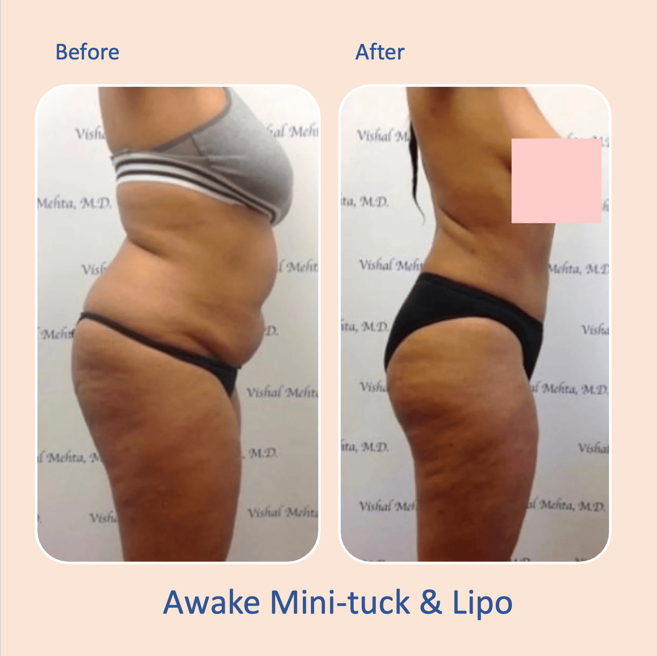 Before & after results of awake mini-tummy tuck and liposuction, lipo-sculpting performed by Dr. Vishal Mehta, top Liposuction Surgeon serving Central NJ, Princeton, Montgomery, and surrounding areas.