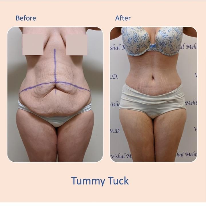 Before & after results of tummy tuck and liposuction, lipo-sculpting performed by Dr. Vishal Mehta, top Liposuction Surgeon serving Central NJ, Princeton, Montgomery, NJ and surrounding areas.