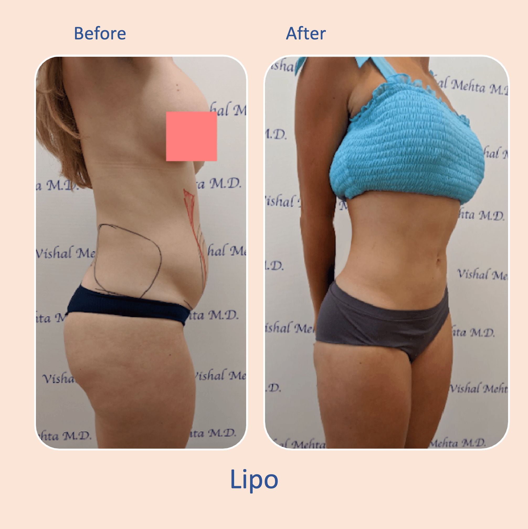 Before & after results of awake liposuction, lipo-sculpting performed by Dr. Vishal Mehta, top Liposuction Surgeon, Central NJ