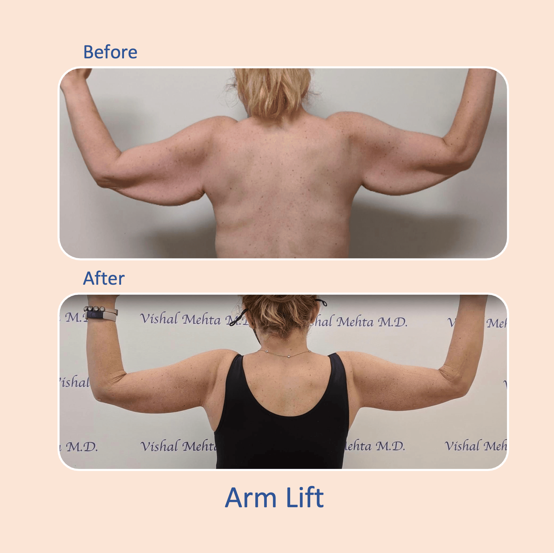 Before & after results of awake liposuction, lipo-sculpting performed by Dr. Vishal Mehta, top Liposuction Surgeon, Central NJ