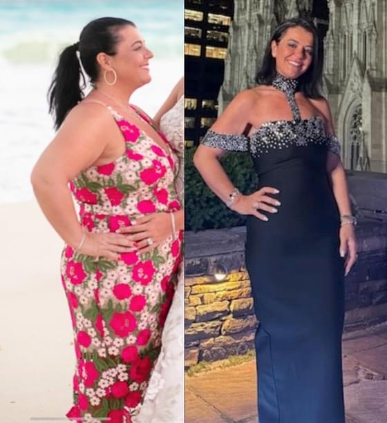 Before & after results of bariatric surgery, gastric sleeve, weight loss surgery, performed by Dr. Vishal Mehta, top bariatric Surgeon serving Central NJ, Princeton, Montgomery, and surrounding areas.