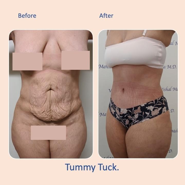Before & after results of tummy tuck and liposuction, lipo-sculpting performed by Dr. Vishal Mehta, top Liposuction Surgeon serving Central NJ, Princeton, Montgomery, NJ and surrounding areas.