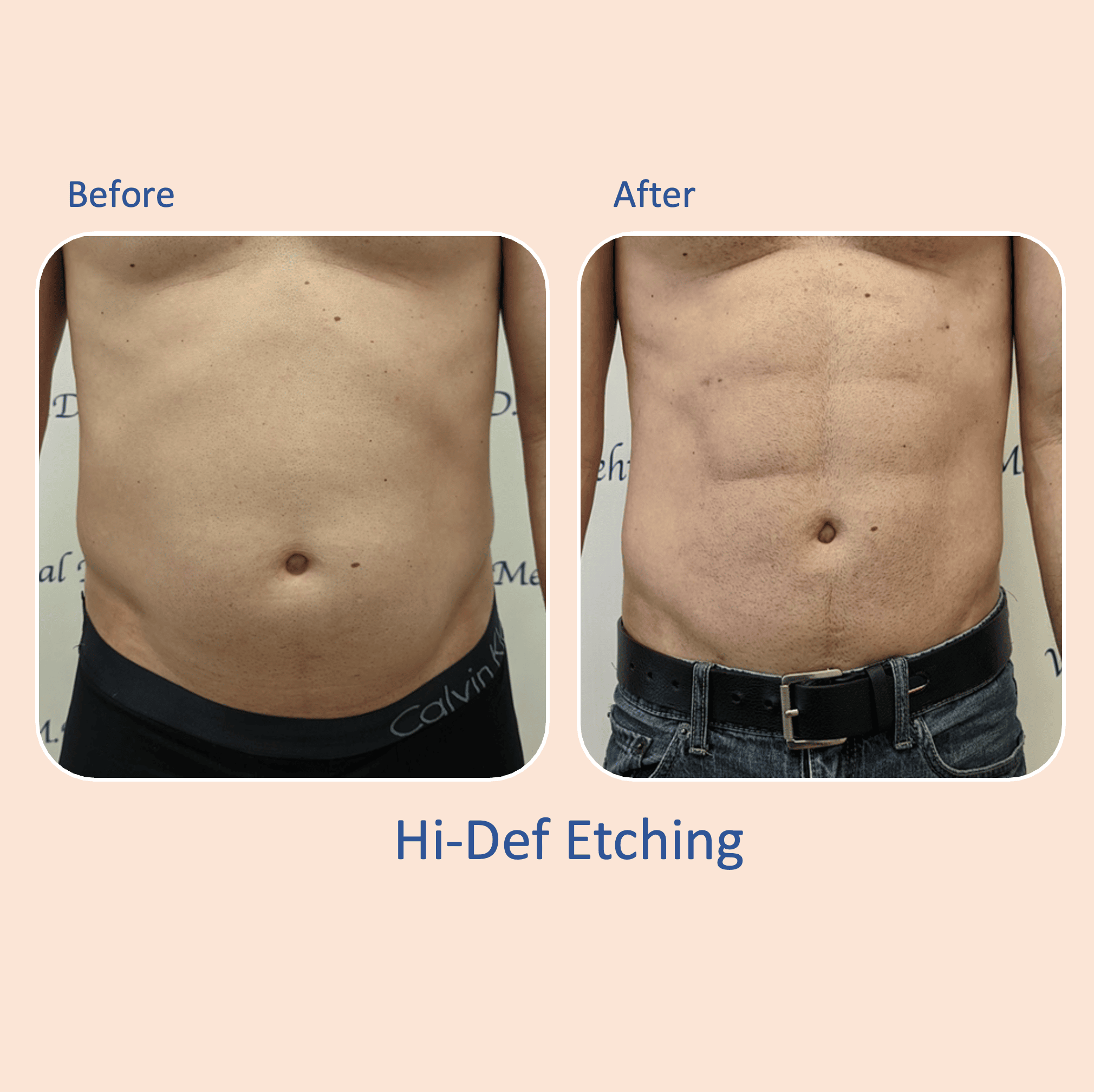 Before & after results of awake liposuction, lipo-sculpting gynecomastia, male chest, performed by Dr. Vishal Mehta, top Liposuction Surgeon, Central NJ
